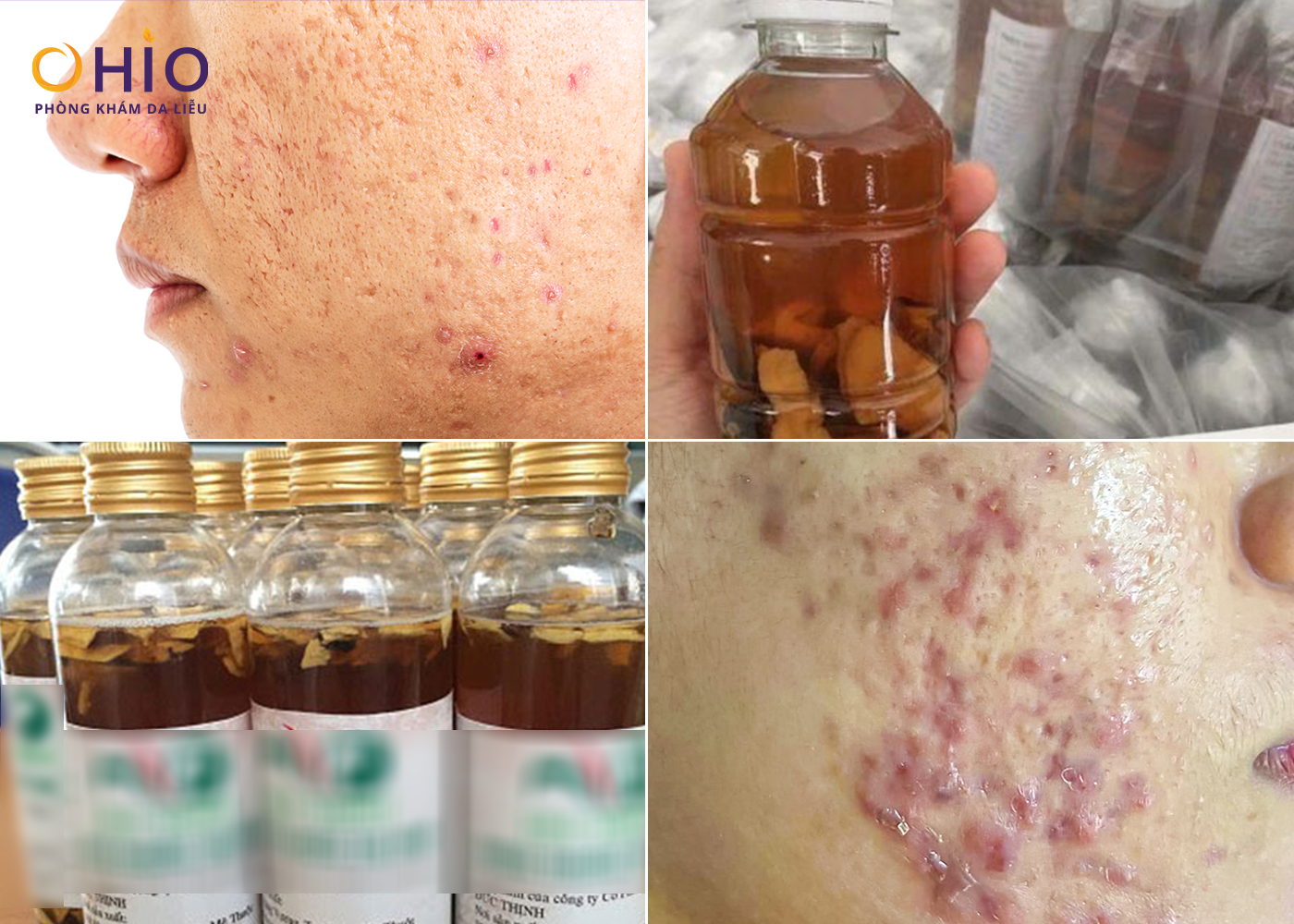 Từ Rượu Thuốc Trị Mụn Đến Di Chứng Sẹo Rỗ: Hành Trình Phục Hồi Làn Da Của chị Thu Huyền