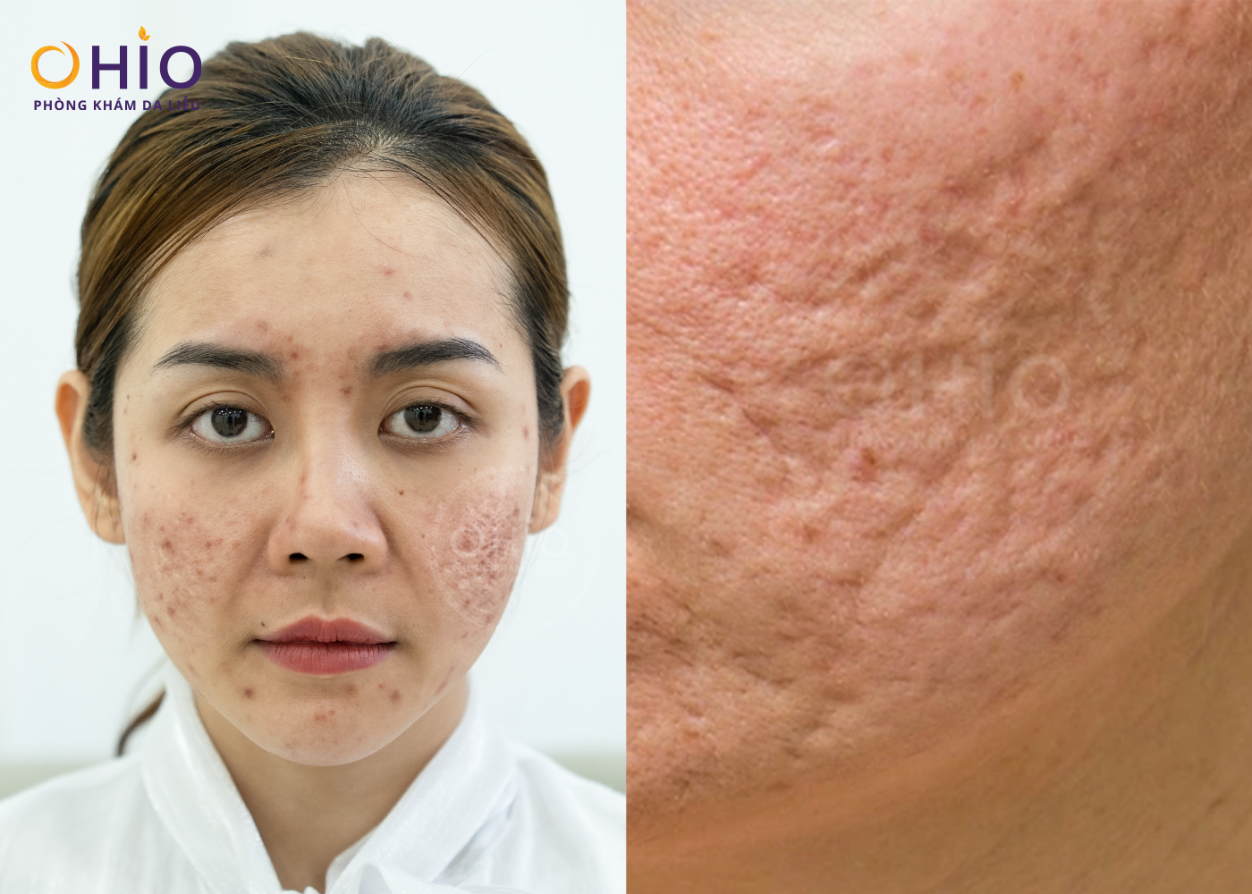 Từ Rượu Thuốc Trị Mụn Đến Di Chứng Sẹo Rỗ: Hành Trình Phục Hồi Làn Da Của chị Thu Huyền