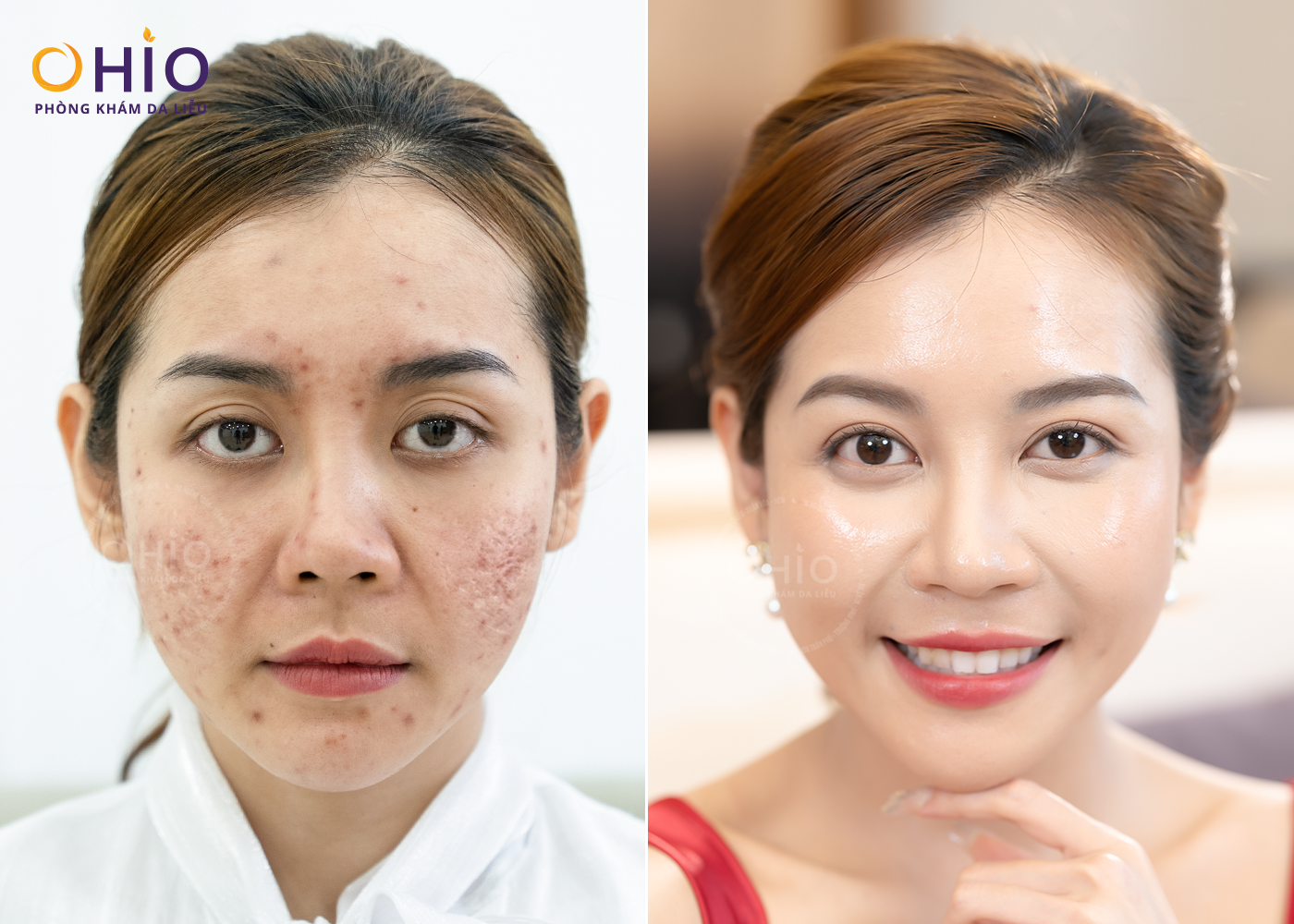 Từ Rượu Thuốc Trị Mụn Đến Di Chứng Sẹo Rỗ: Hành Trình Phục Hồi Làn Da Của chị Thu Huyền