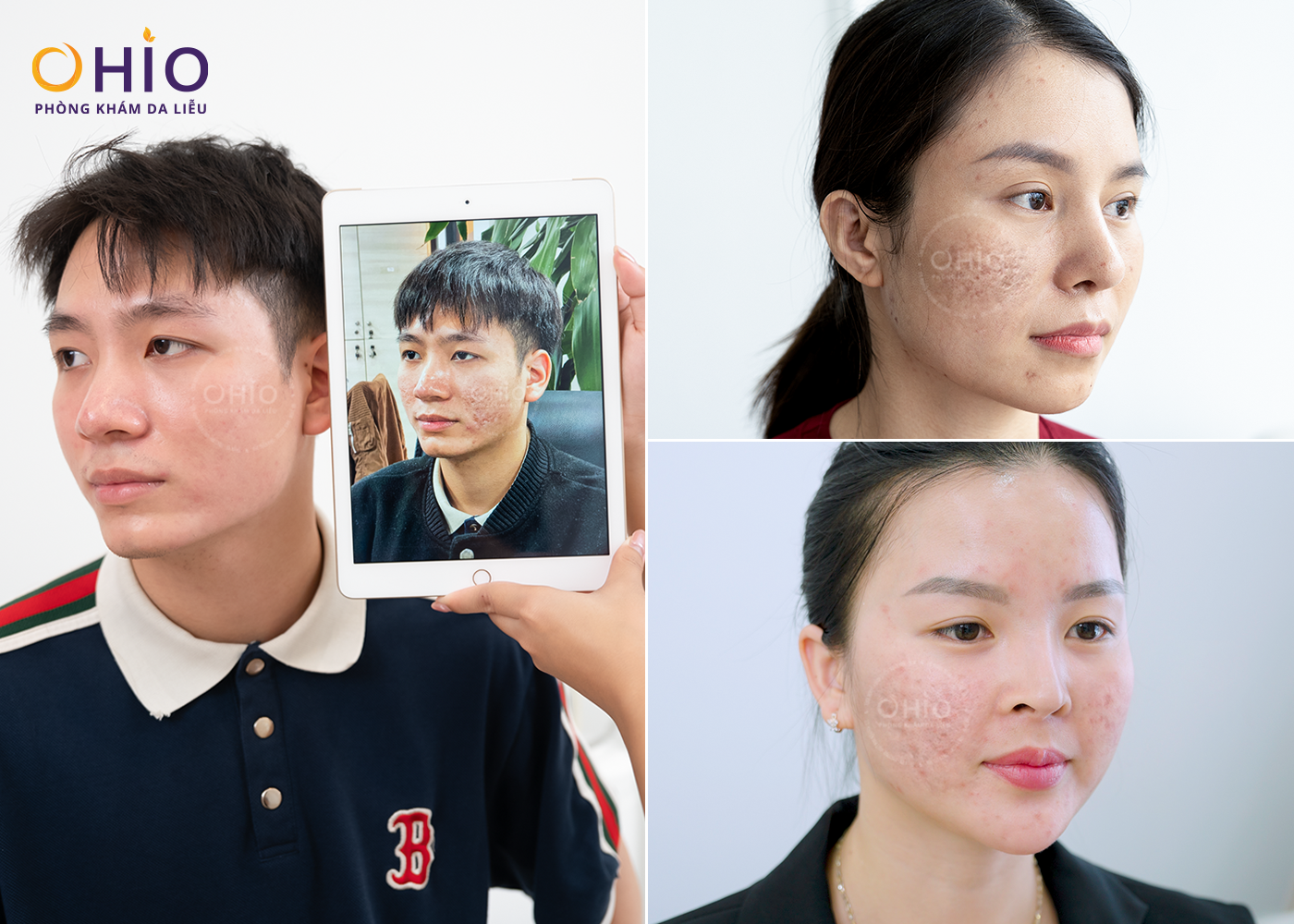 điều trị sẹo rỗ 