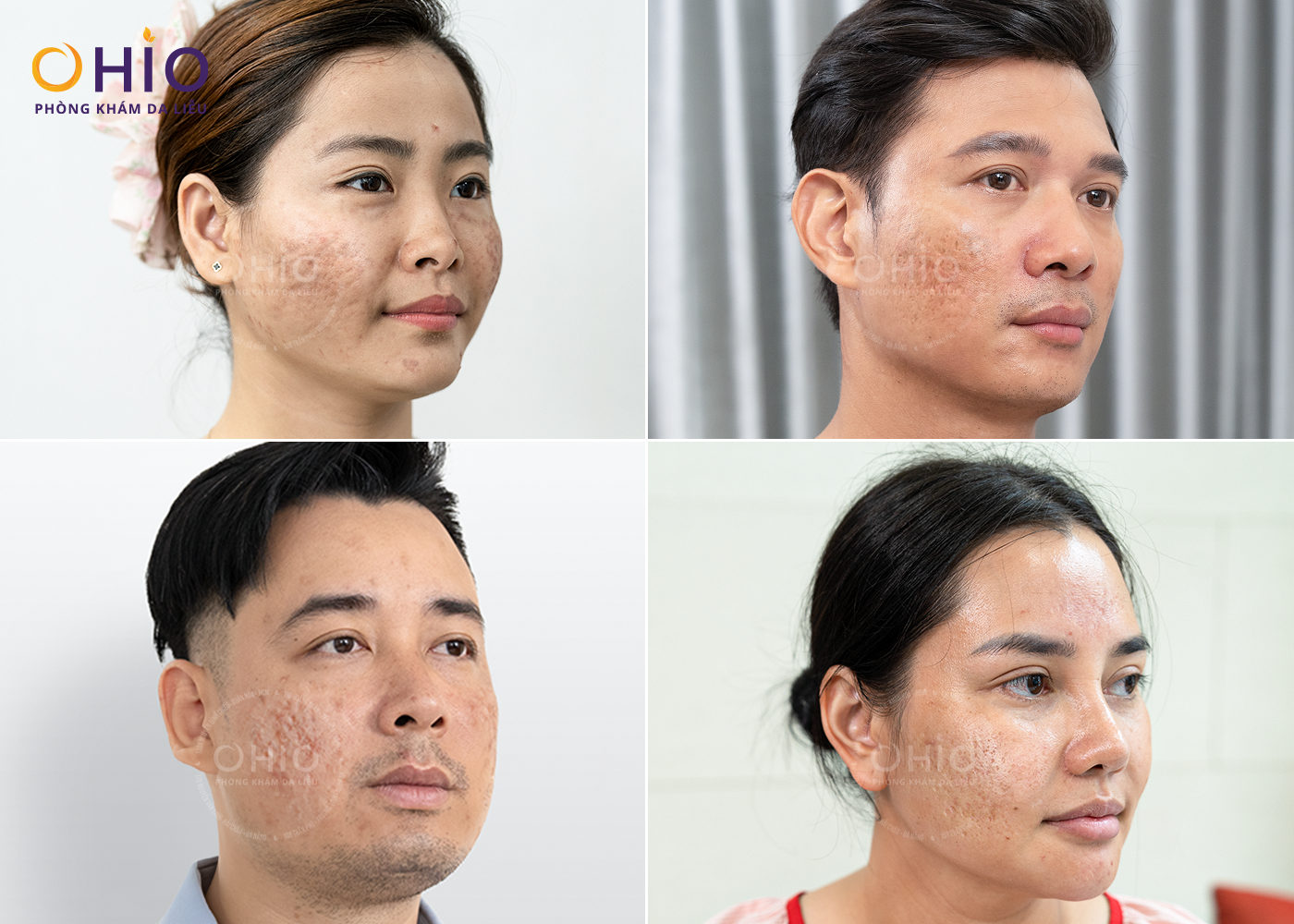 điều trị sẹo rỗ tại Đà Nẵng