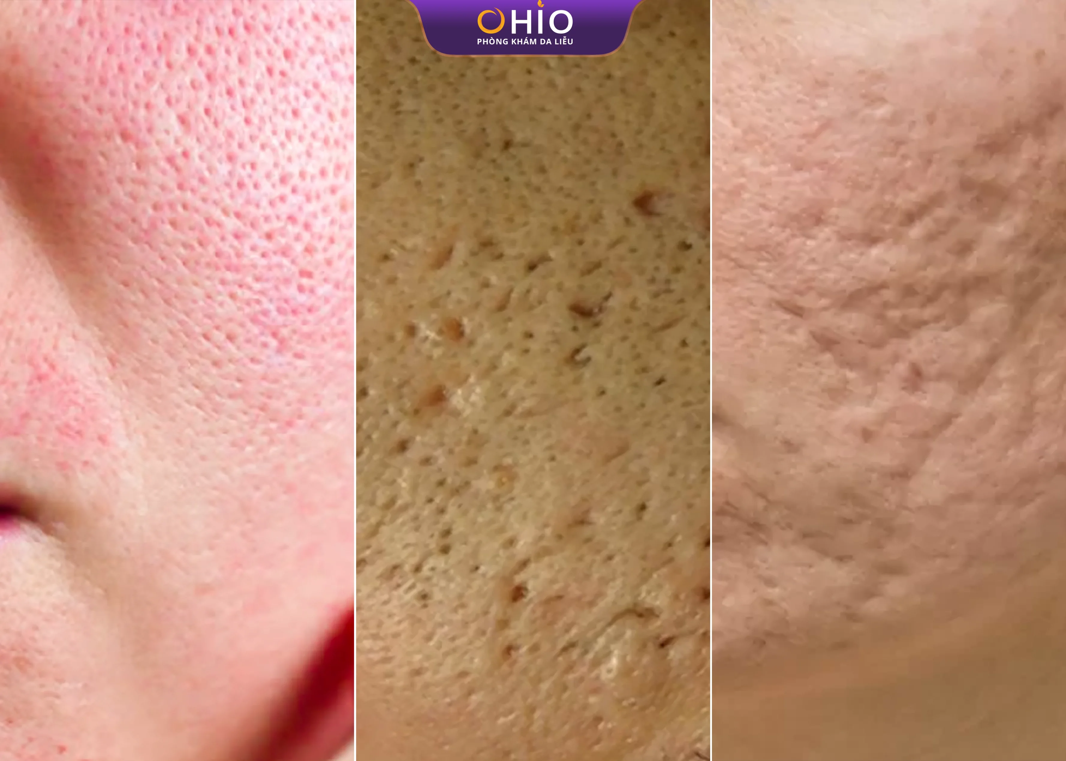 Trị sẹo rỗ tại Vinh ở đâu an toàn, hiệu quả? Những điều cần biết trước khi lựa chọn - Phòng khám da liễu OHIO điều trị sẹo rỗ tại Vinh