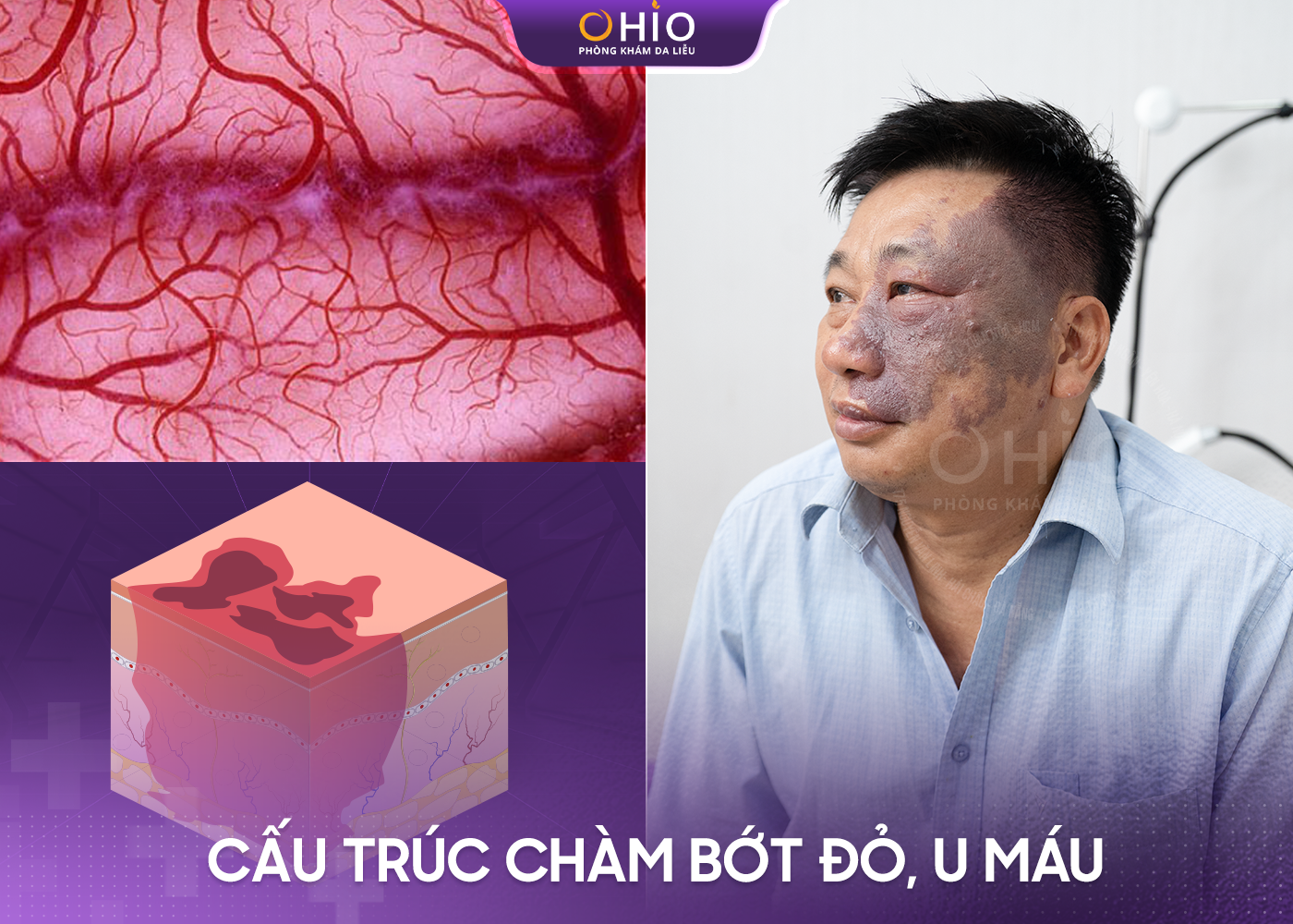 chàm bớt đỏ bẩm sinh