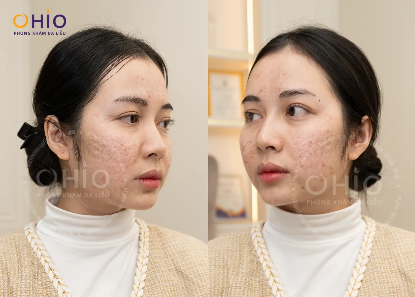 Sẹo Rỗ Lâu Năm Có Thể Cải Thiện Hiệu Quả? Bác Sĩ Nguyễn Thế Anh Phân Tích Dưới Góc Độ Da Liễu - Phòng khám da liễu OHIO Sẹo Rỗ Lâu Năm Có Thể Cải Thiện Hiệu Quả? Bác Sĩ Nguyễn Thế Anh Phân Tích Dưới Góc Độ Da Liễu