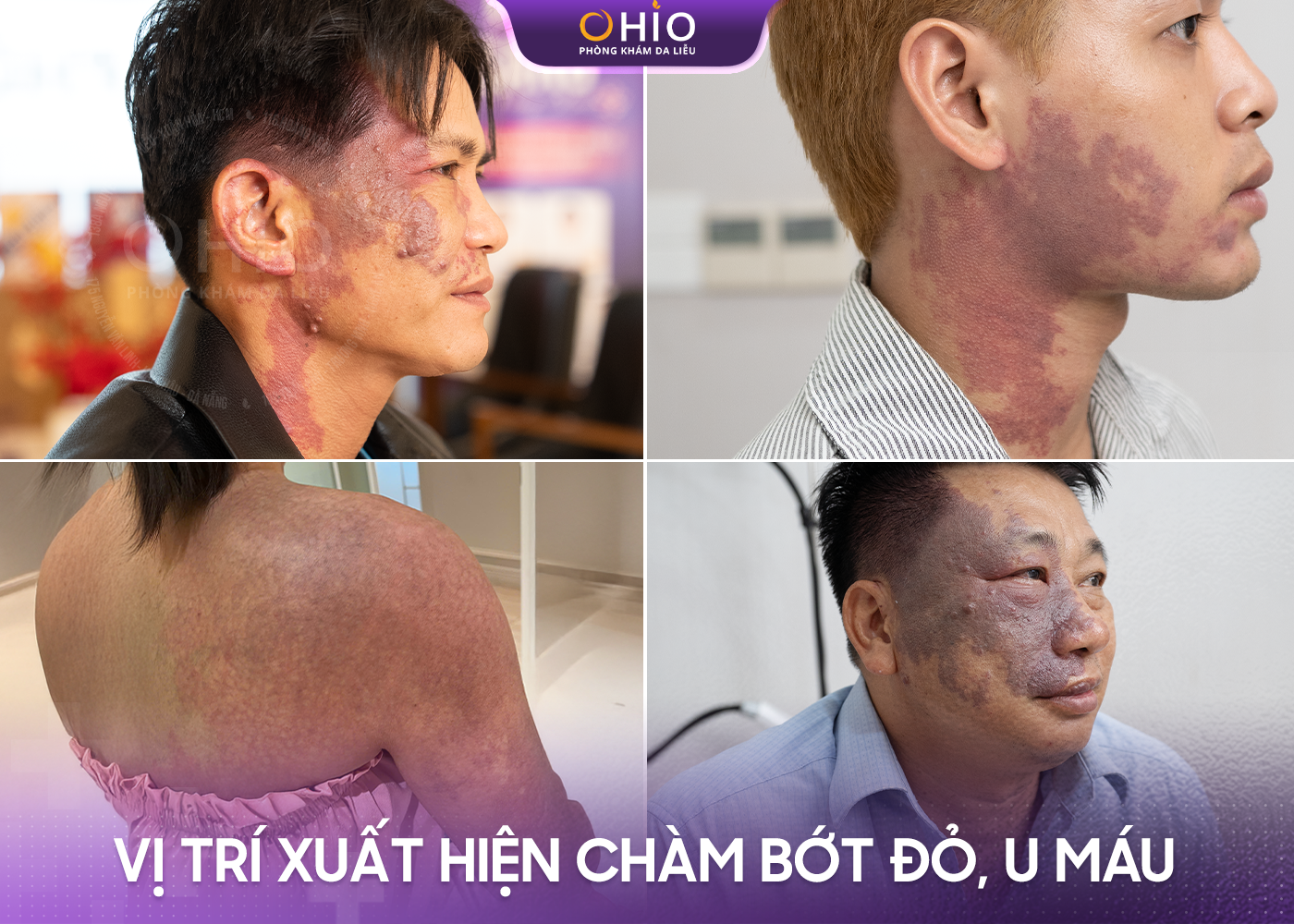 Chàm bớt đỏ bẩm sinh có xóa được không? - Phòng khám da liễu OHIO Chàm bớt đỏ bẩm sinh có xóa được không?