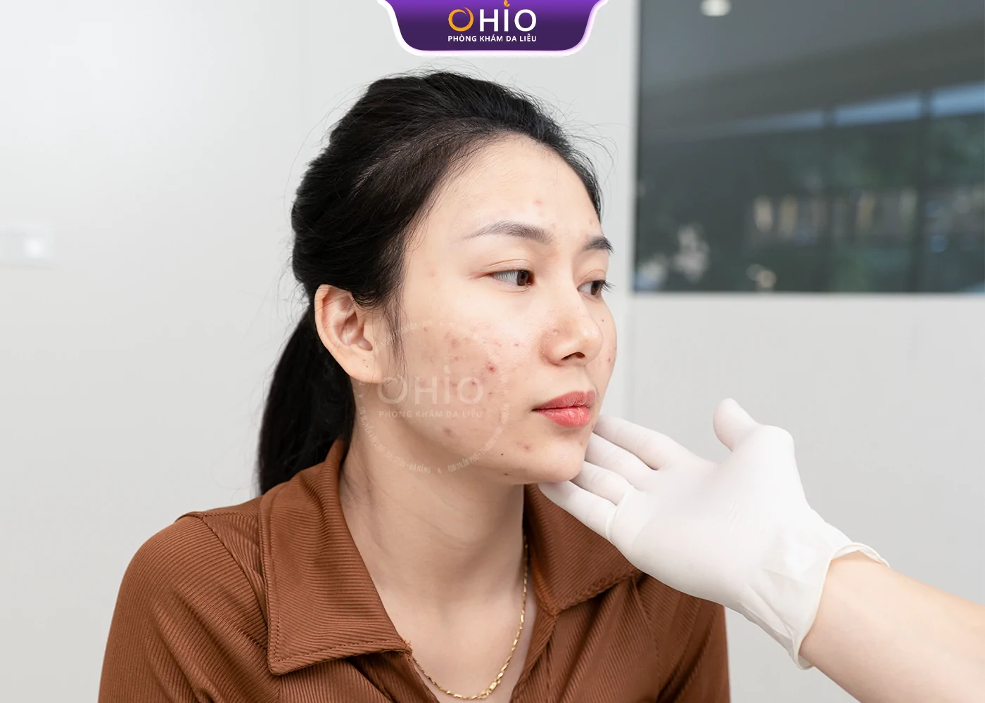Trị sẹo rỗ tại Vinh ở đâu an toàn, hiệu quả? Những điều cần biết trước khi lựa chọn - Phòng khám da liễu OHIO sẹo rỗ