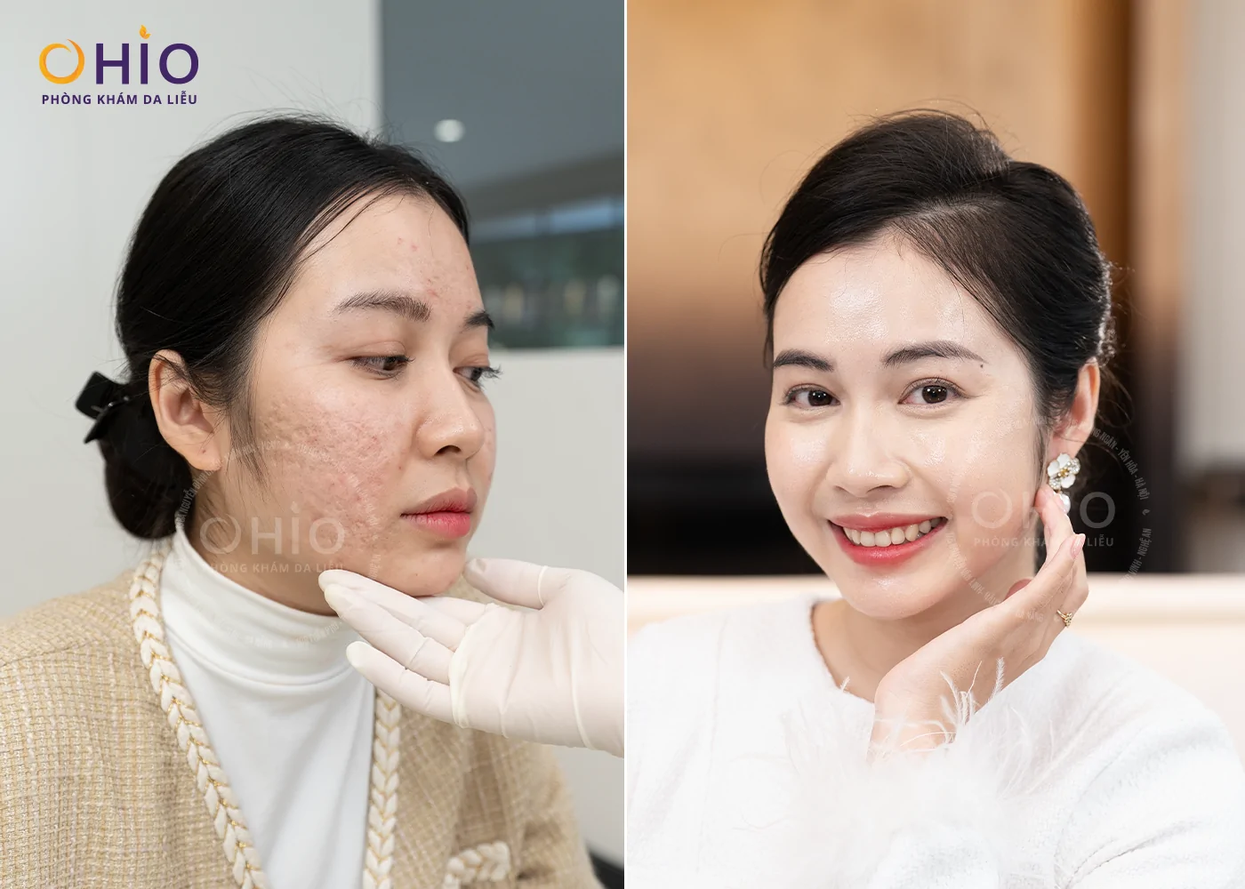 Sẹo Rỗ Lâu Năm Có Thể Cải Thiện Hiệu Quả? Bác Sĩ Nguyễn Thế Anh Phân Tích Dưới Góc Độ Da Liễu - Phòng khám da liễu OHIO Sẹo Rỗ Lâu Năm Có Thể Cải Thiện Hiệu Quả? Bác Sĩ Nguyễn Thế Anh Phân Tích Dưới Góc Độ Da Liễu