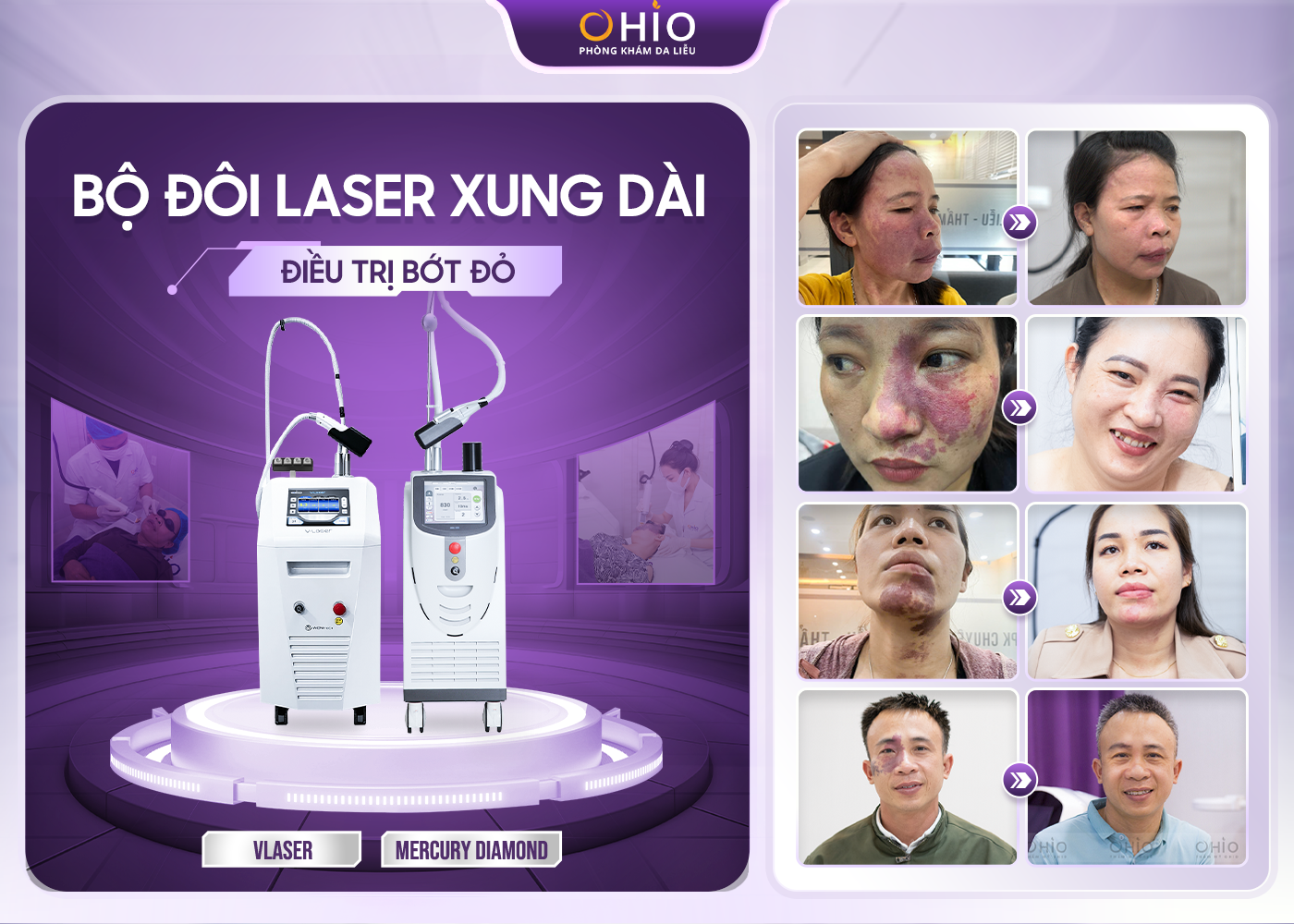 Chàm bớt đỏ bẩm sinh có xóa được không? - Phòng khám da liễu OHIO Chàm bớt đỏ bẩm sinh có xóa được không?