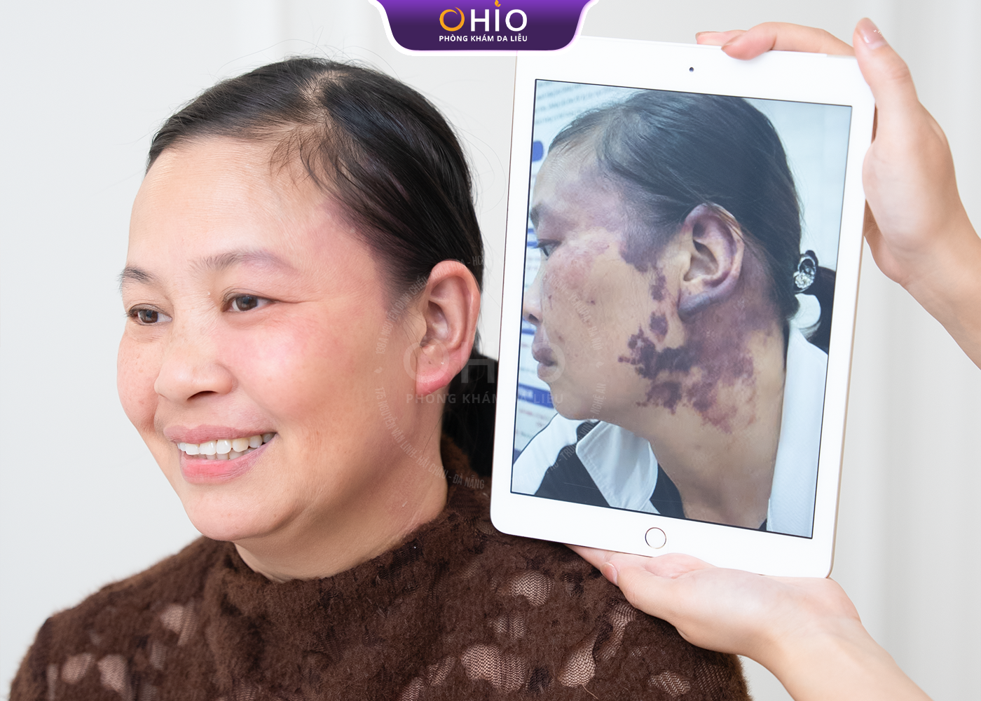 Chàm bớt đỏ bẩm sinh có xóa được không?