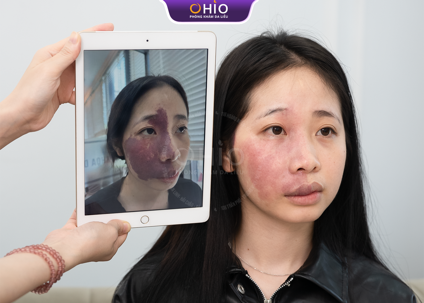 Chàm bớt đỏ bẩm sinh có xóa được không? - Phòng khám da liễu OHIO Chàm bớt đỏ bẩm sinh có xóa được không?