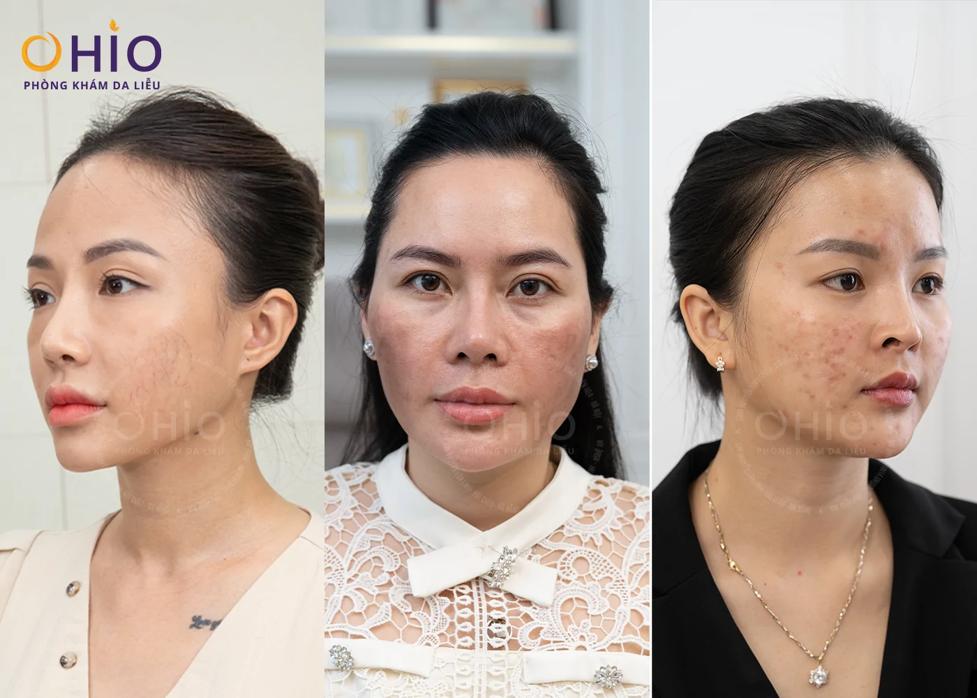 “SKIN RESET DAY” - NGÀY HỘI TÁI TẠO LÀN DA TOÀN DIỆN SẮP DIỄN RA TRONG KHUÔN KHỔ THUỘC CHIẾN DỊCH OHIO SUMMER RESET - Phòng khám da liễu OHIO “SKIN RESET DAY” - NGÀY HỘI TÁI TẠO LÀN DA TOÀN DIỆN SẮP DIỄN RA TRONG KHUÔN KHỔ THUỘC CHIẾN DỊCH OHIO SUMMER RESET