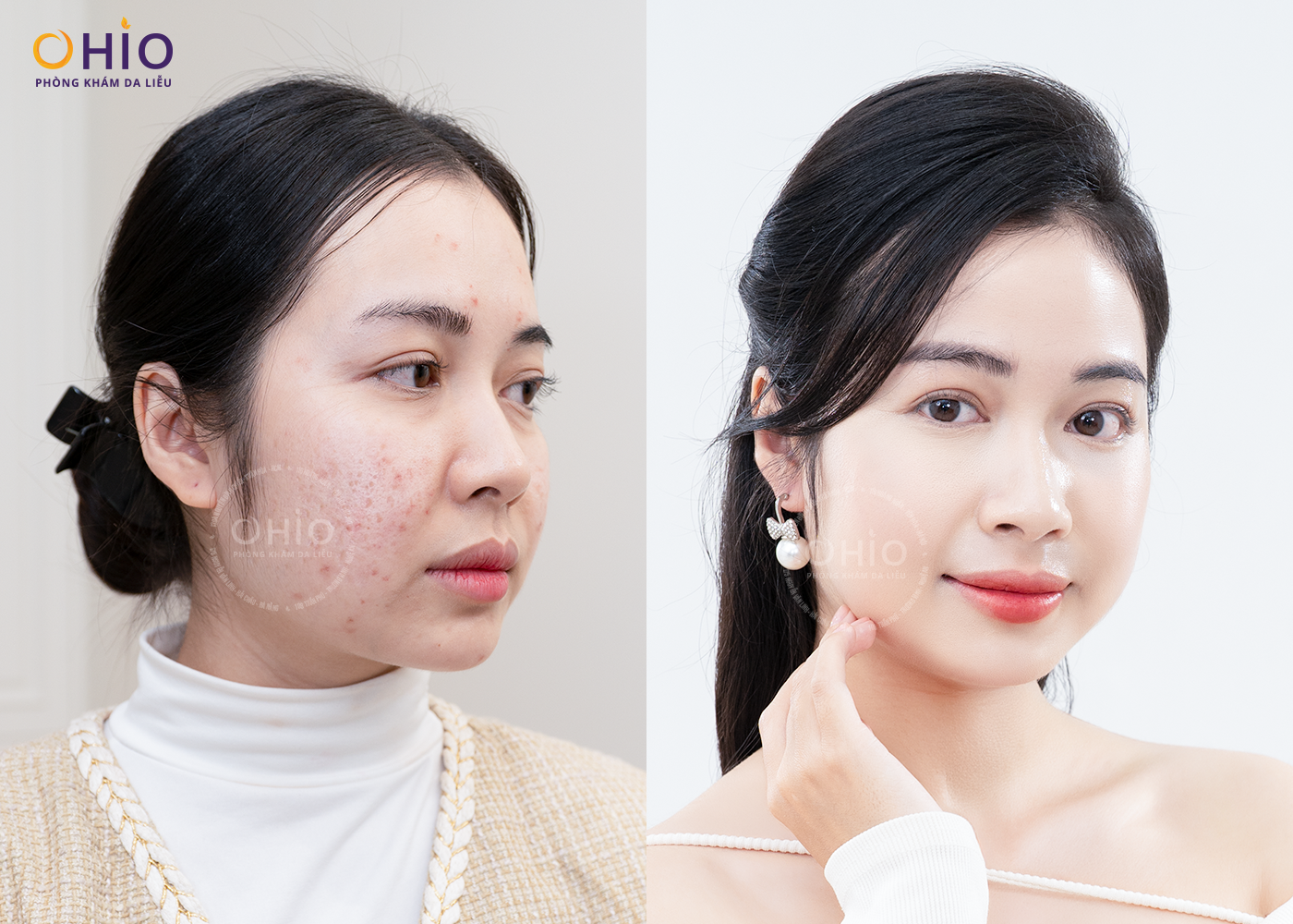 KHÁM PHÁ “SKIN RESET DAY” – NGÀY HỘI TÁI TẠO LÀN DA CHUYÊN SÂU TẠI OHIO