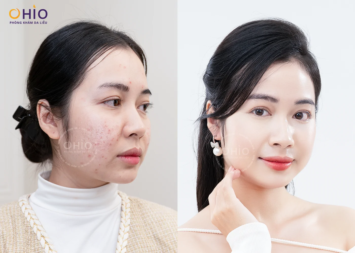 KHÁM PHÁ “SKIN RESET DAY” – NGÀY HỘI TÁI TẠO LÀN DA CHUYÊN SÂU TẠI OHIO - Phòng khám da liễu OHIO KHÁM PHÁ “SKIN RESET DAY” – NGÀY HỘI TÁI TẠO LÀN DA CHUYÊN SÂU TẠI OHIO