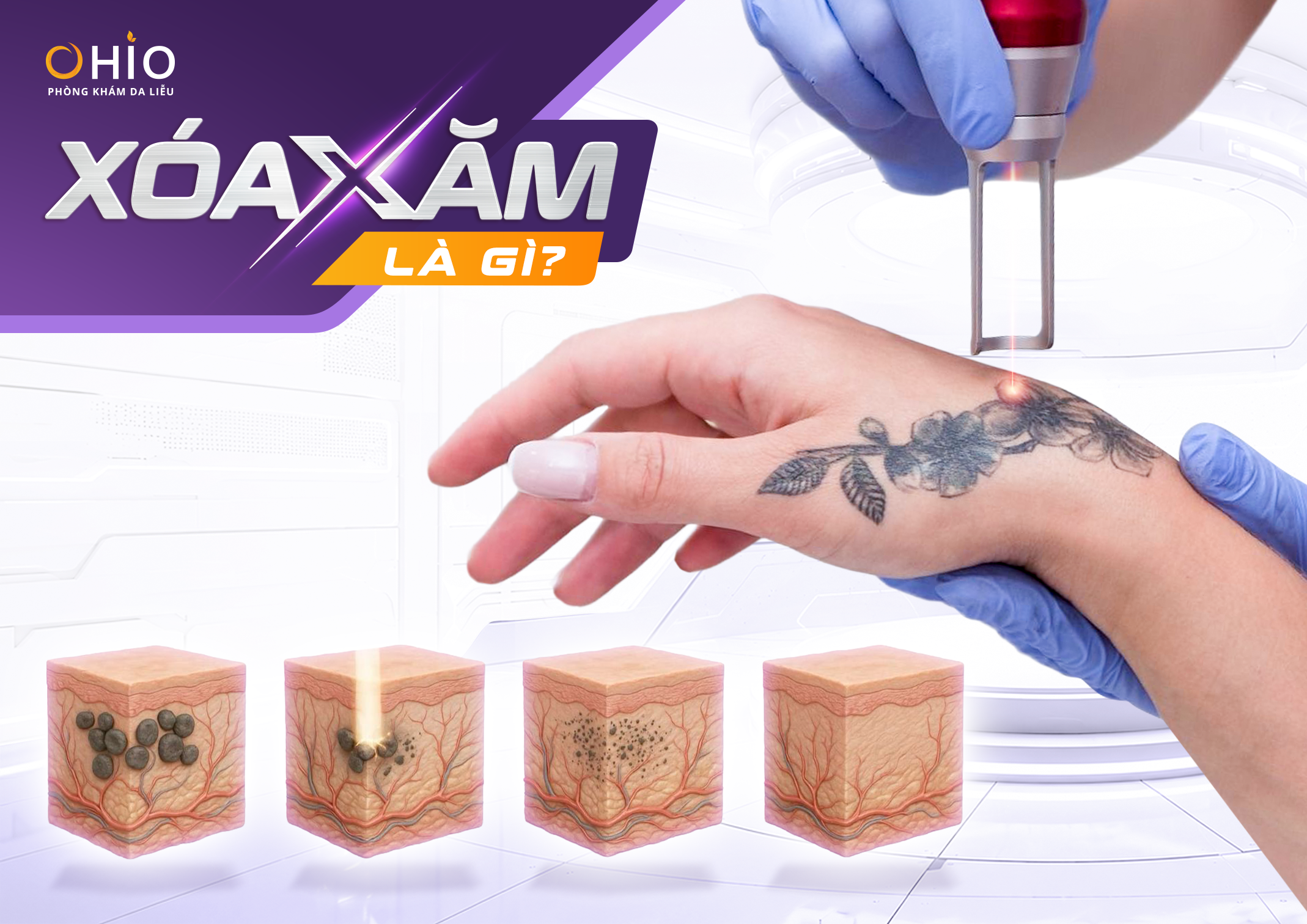 Xoá xăm có đau không? có để lại sẹo không? BS.CK1 chuyên ngành Da liễu giải đáp - Phòng khám da liễu OHIO Xoá xăm có đau không? có để lại sẹo không? BS.CK1 chuyên ngành Da liễu giải đáp
