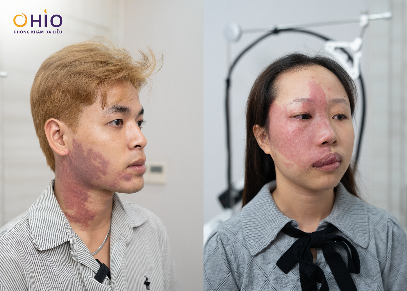 Vết bớt rượu vang: Nguyên nhân, dấu hiệu và cách điều trị hiệu quả - Phòng khám da liễu OHIO Vết bớt rượu vang: Nguyên nhân, dấu hiệu và cách điều trị hiệu quả
