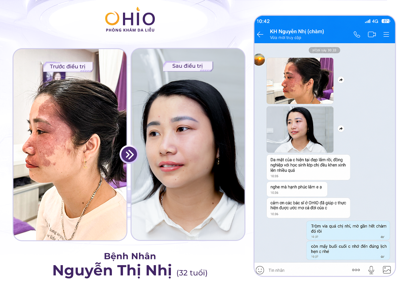 Vết bớt rượu vang: Nguyên nhân, dấu hiệu và cách điều trị hiệu quả - Phòng khám da liễu OHIO Vết bớt rượu vang: Nguyên nhân, dấu hiệu và cách điều trị hiệu quả