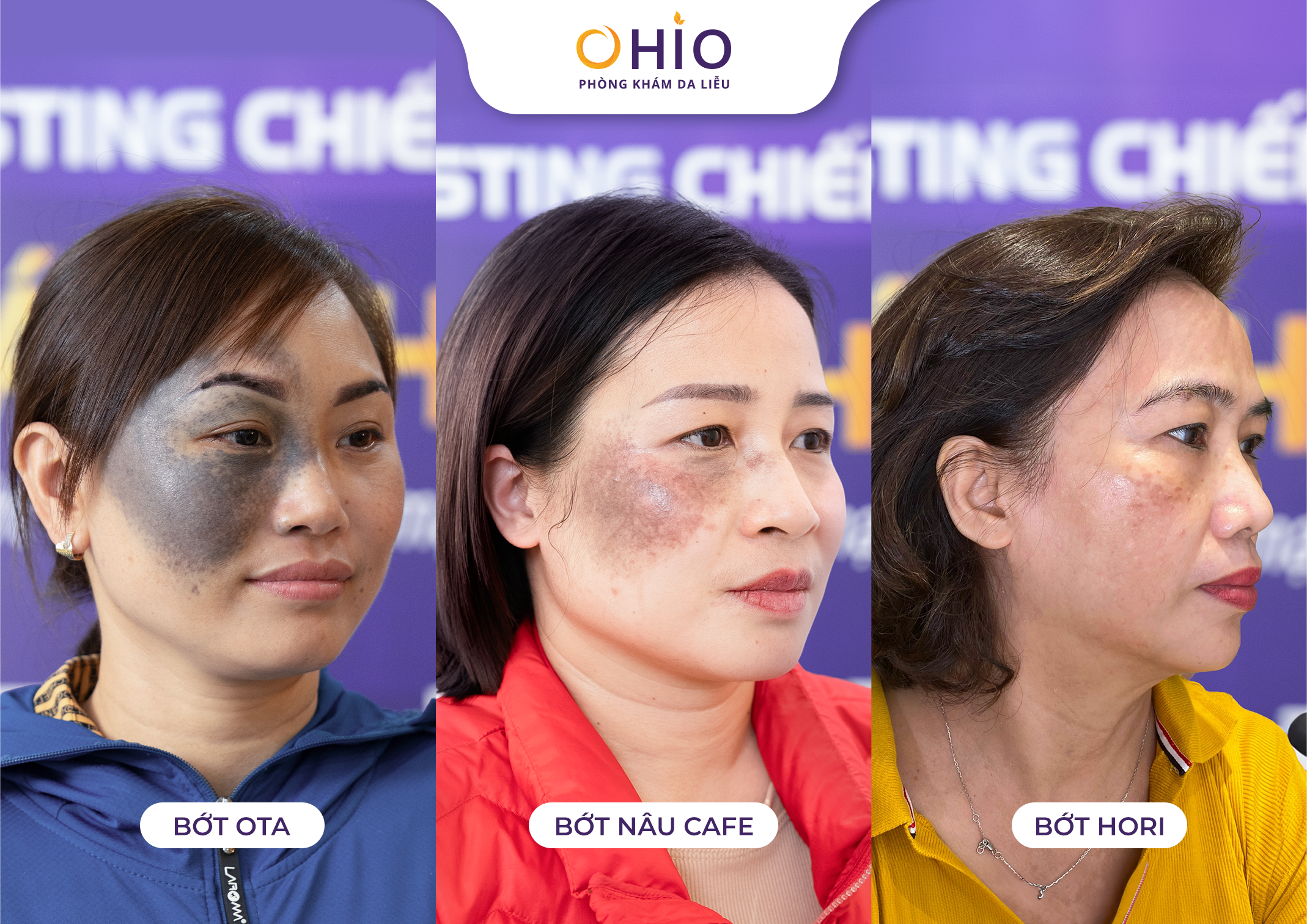Xóa chàm bớt sắc tố tại OHIO và những điều cần biết