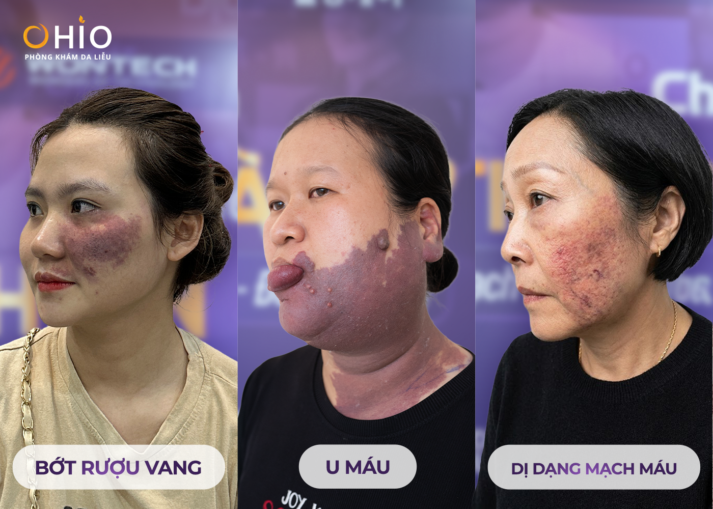 Vết bớt rượu vang: Nguyên nhân, dấu hiệu và cách điều trị hiệu quả - Phòng khám da liễu OHIO Vết bớt rượu vang: Nguyên nhân, dấu hiệu và cách điều trị hiệu quả