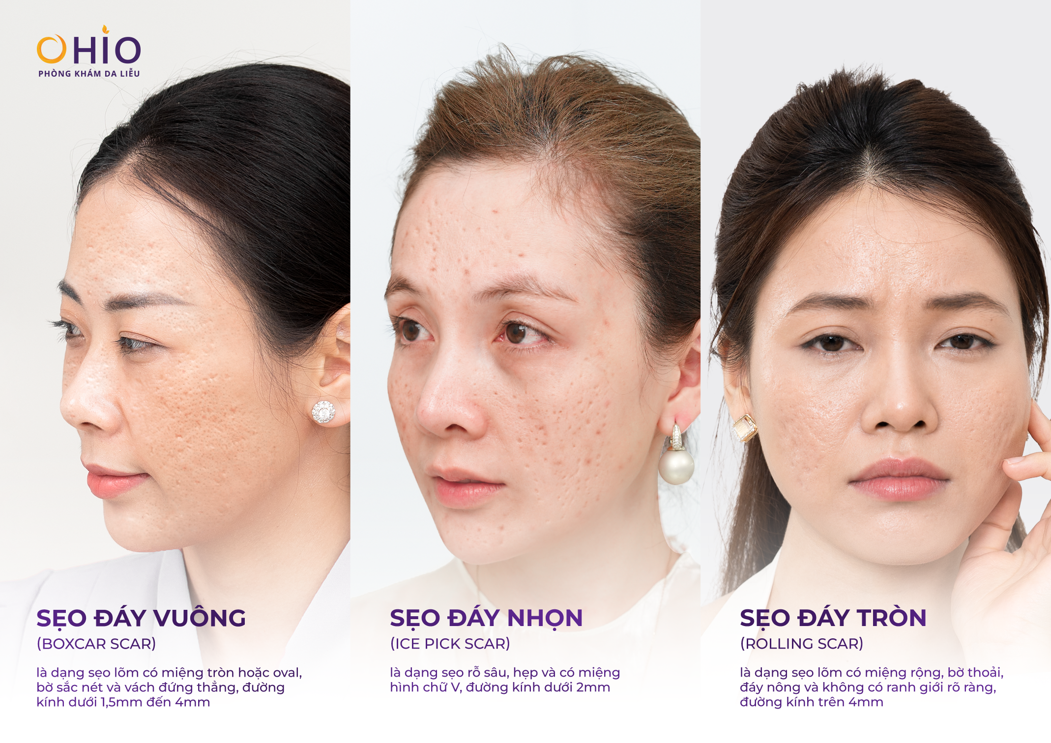 90% Người Trị Sẹo Rỗ Đang Điều Trị Sai Cách Mà Không Biết