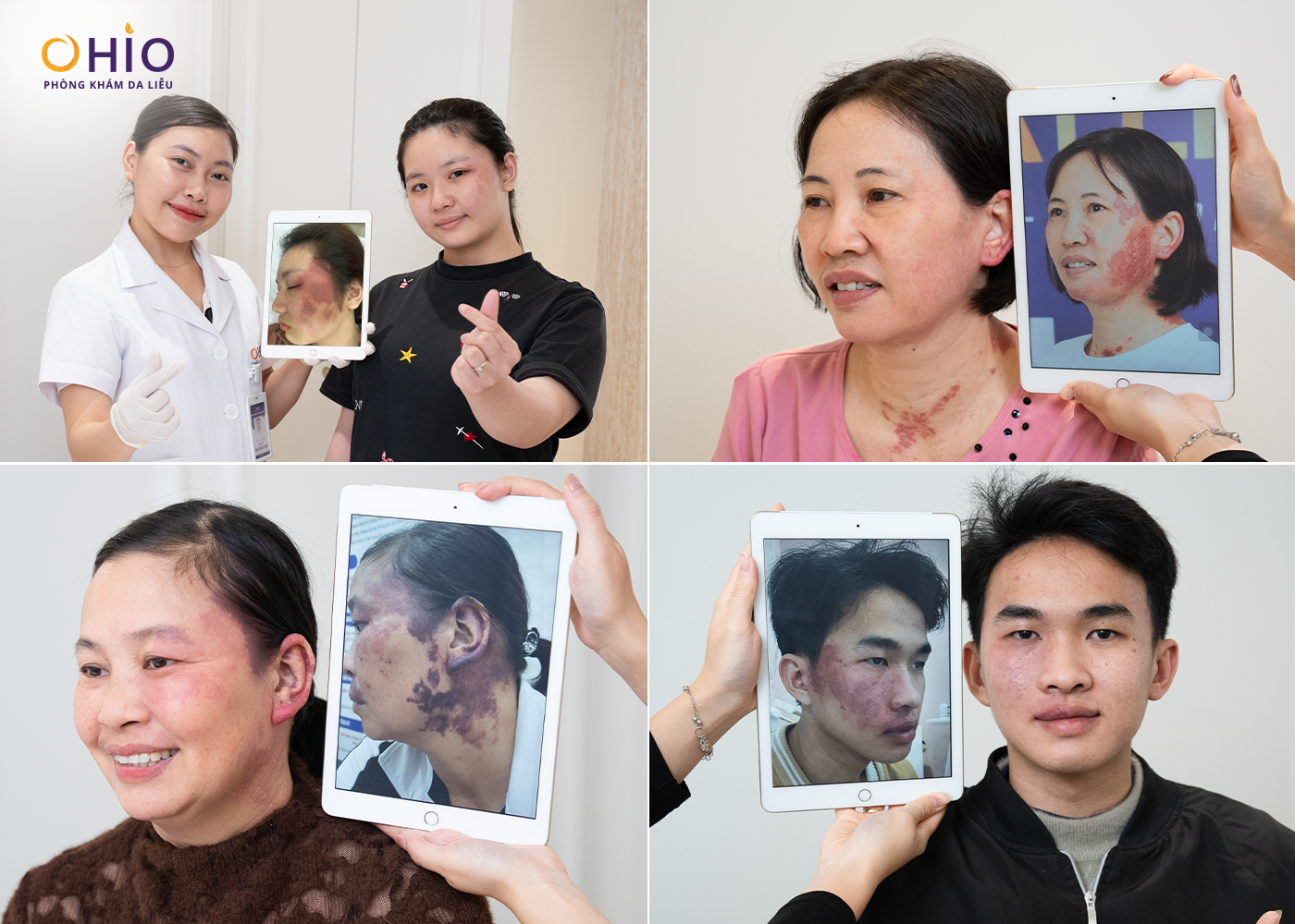 Vết bớt rượu vang: Nguyên nhân, dấu hiệu và cách điều trị hiệu quả - Phòng khám da liễu OHIO Vết bớt rượu vang: Nguyên nhân, dấu hiệu và cách điều trị hiệu quả