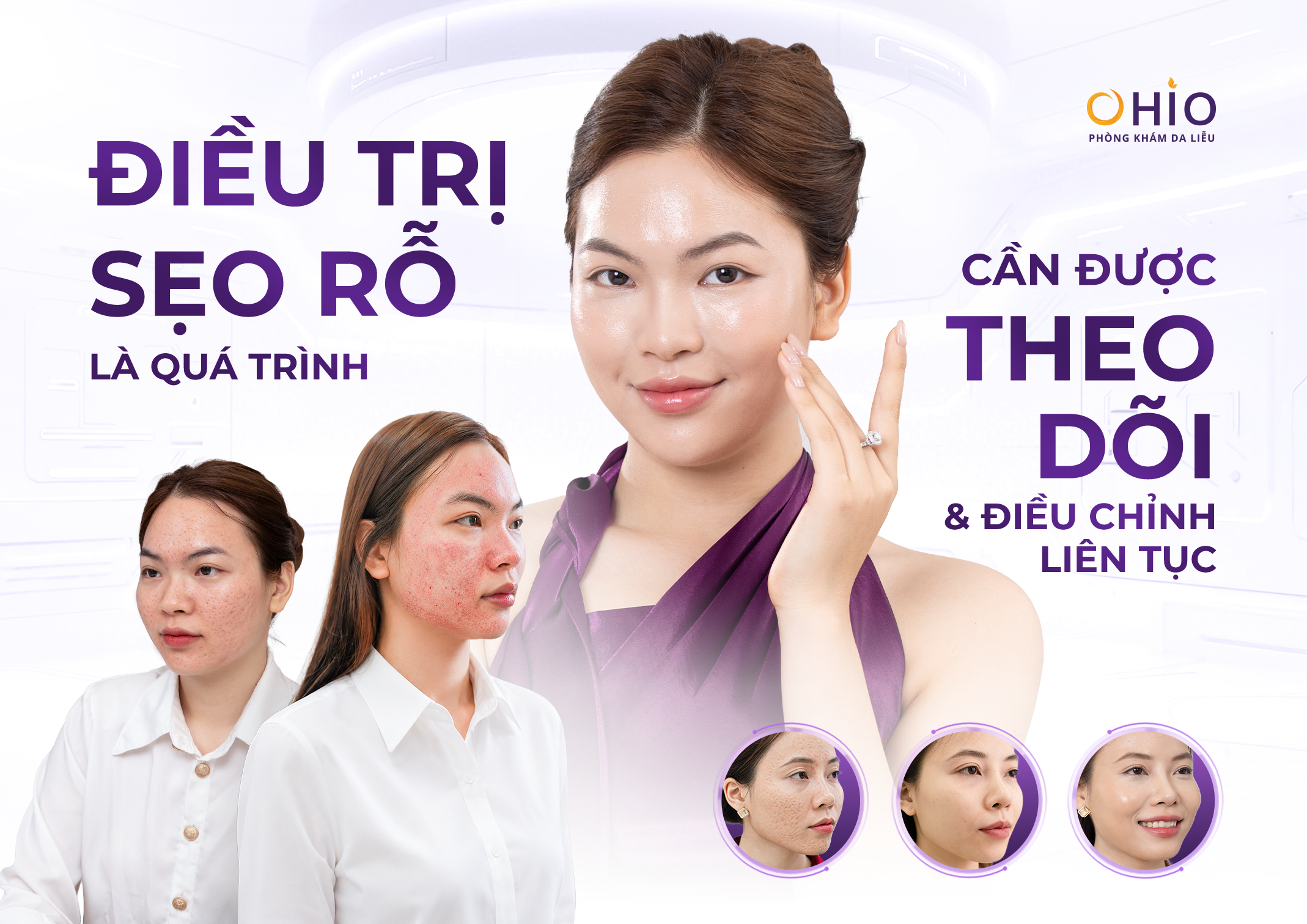 90% Người Trị Sẹo Rỗ Đang Điều Trị Sai Cách Mà Không Biết