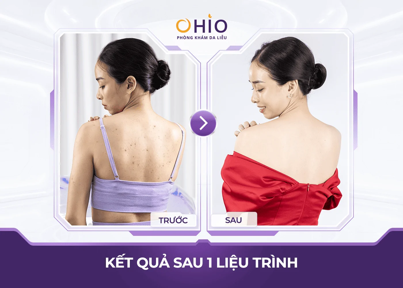 Điều trị viêm nang lông bằng công nghệ cao: Hiệu quả đến đâu, có rủi ro gì? - Phòng khám da liễu OHIO Điều trị viêm nang lông bằng công nghệ cao: Hiệu quả đến đâu, có rủi ro gì?