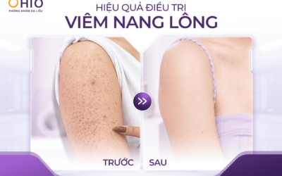 Viêm nang lông có điều trị được không? Góc nhìn từ những khách hàng đã cải thiện tại OHIO