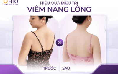 Viêm nang lông có điều trị được không? Góc nhìn từ những khách hàng đã cải thiện tại OHIO