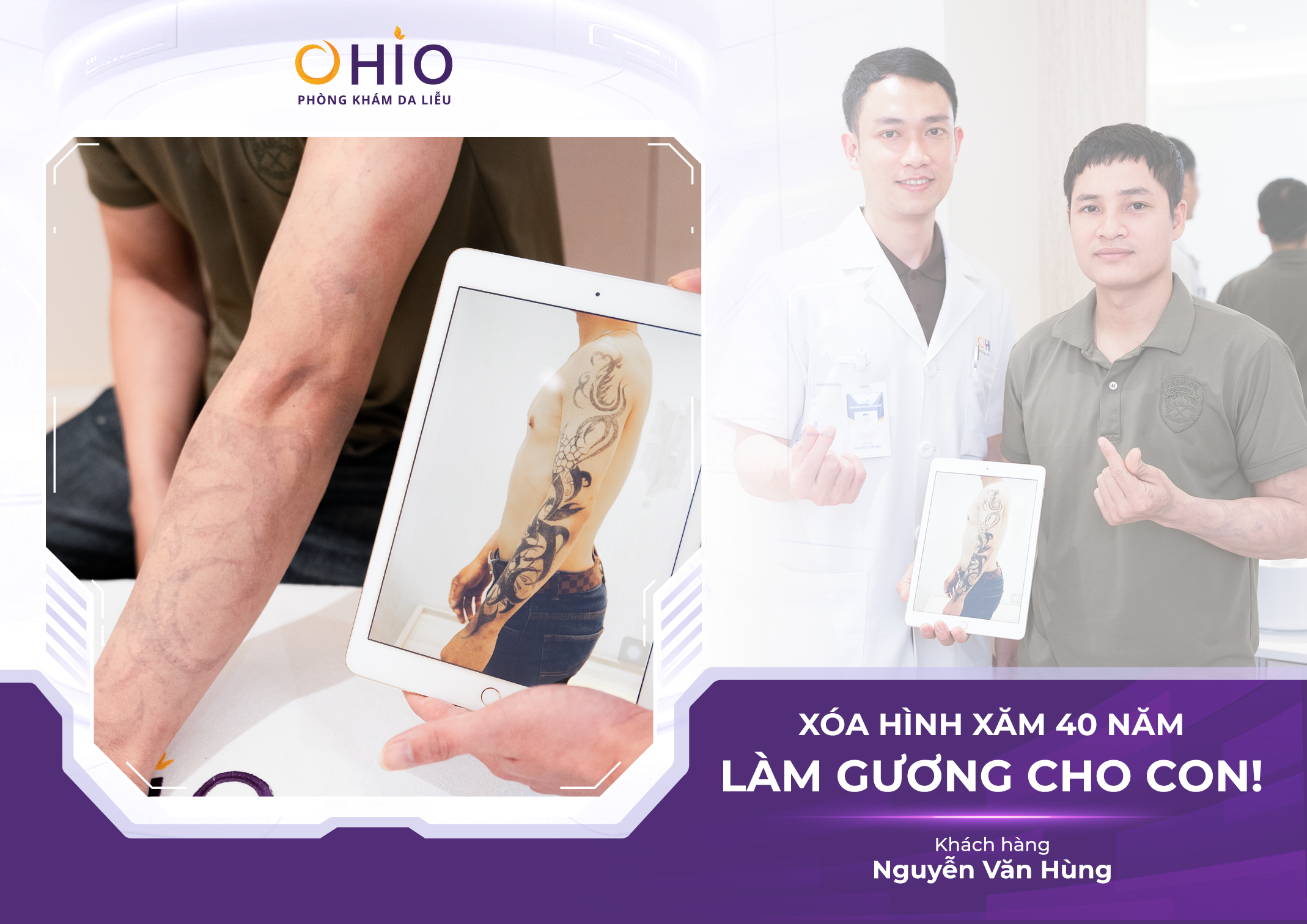 Xoá xăm có đau không? có để lại sẹo không? BS.CK1 chuyên ngành Da liễu giải đáp - Phòng khám da liễu OHIO Xoá xăm có đau không? có để lại sẹo không? BS.CK1 chuyên ngành Da liễu giải đáp