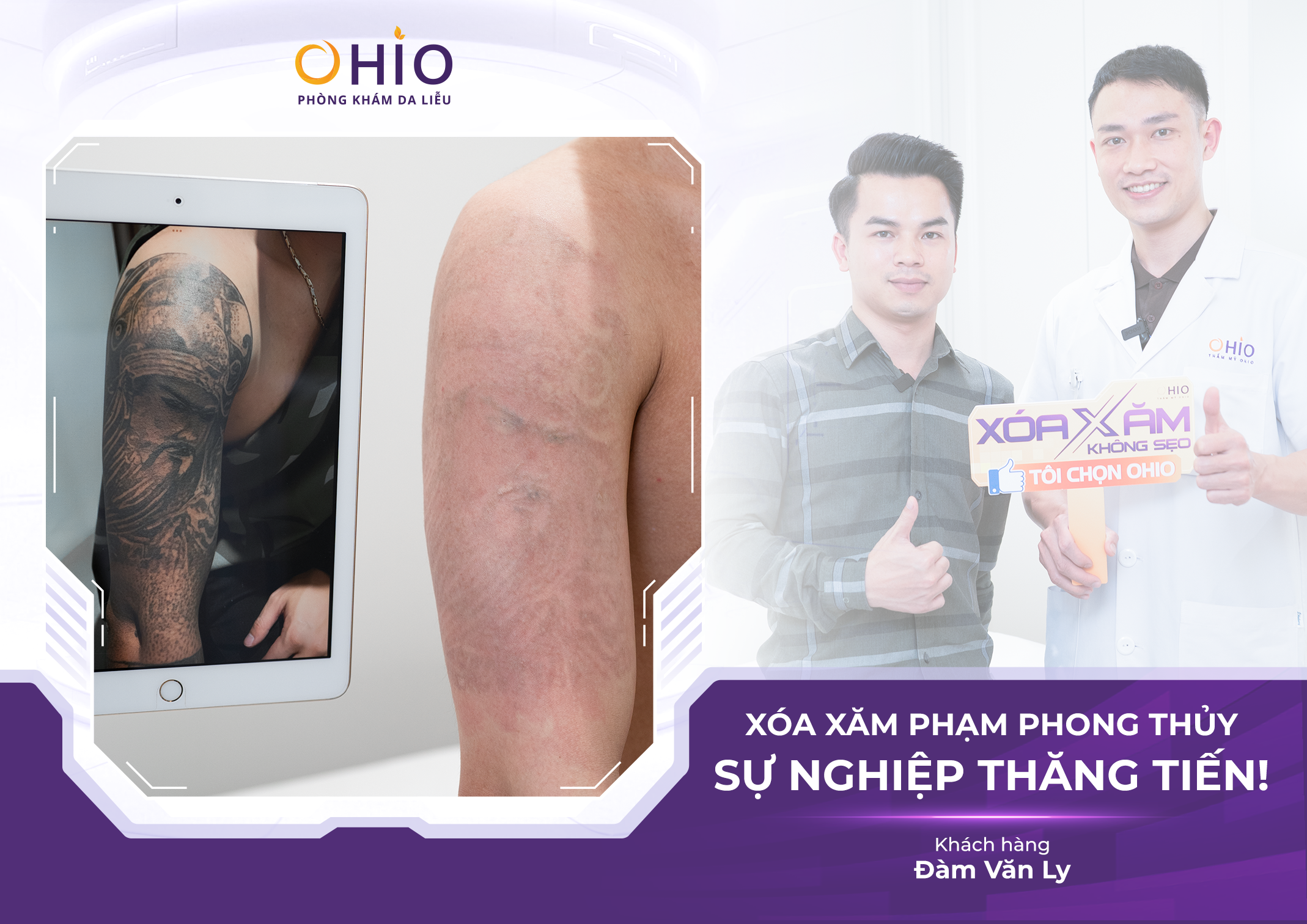 Xoá xăm có đau không? có để lại sẹo không? BS.CK1 chuyên ngành Da liễu giải đáp - Phòng khám da liễu OHIO Xoá xăm có đau không? có để lại sẹo không? BS.CK1 chuyên ngành Da liễu giải đáp