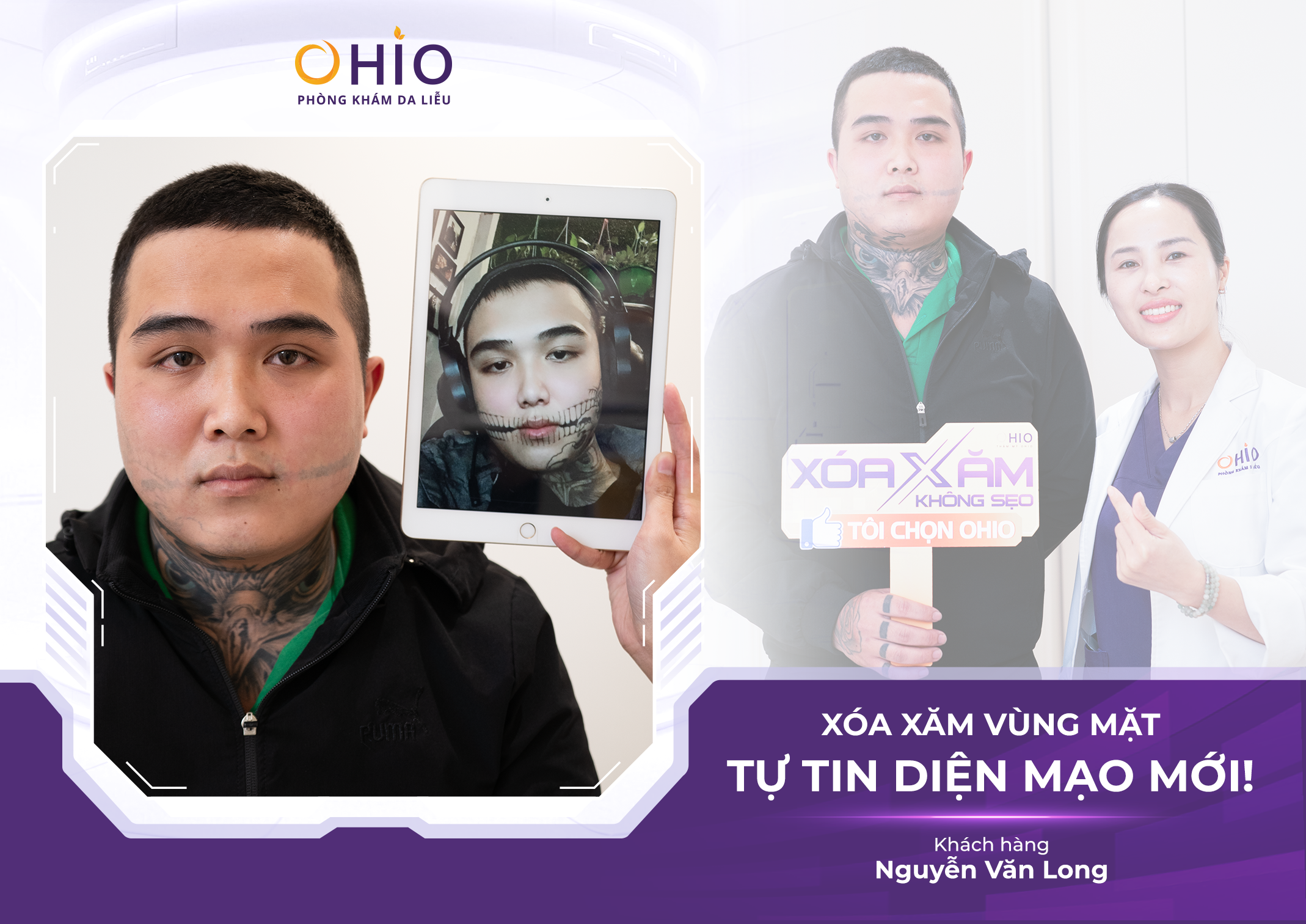 Xoá xăm có đau không? có để lại sẹo không? BS.CK1 chuyên ngành Da liễu giải đáp - Phòng khám da liễu OHIO Xoá xăm có đau không? có để lại sẹo không? BS.CK1 chuyên ngành Da liễu giải đáp
