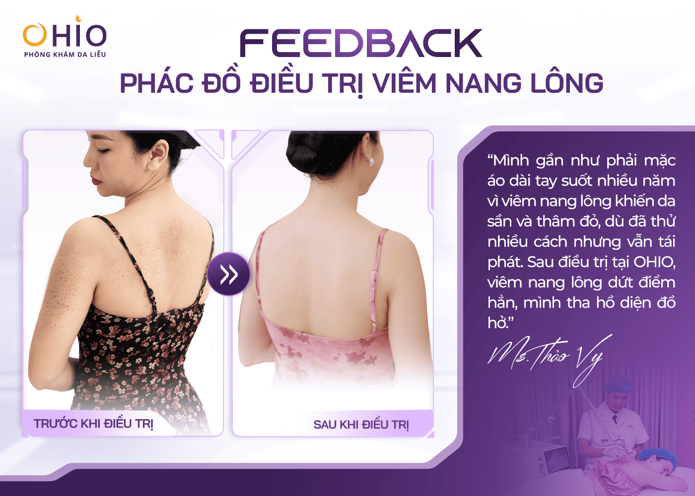 Viêm nang lông: Nhận biết sớm, phòng ngừa và hướng điều trị đúng cách - Phòng khám da liễu OHIO Viêm nang lông: Nhận biết sớm, phòng ngừa và hướng điều trị đúng cách