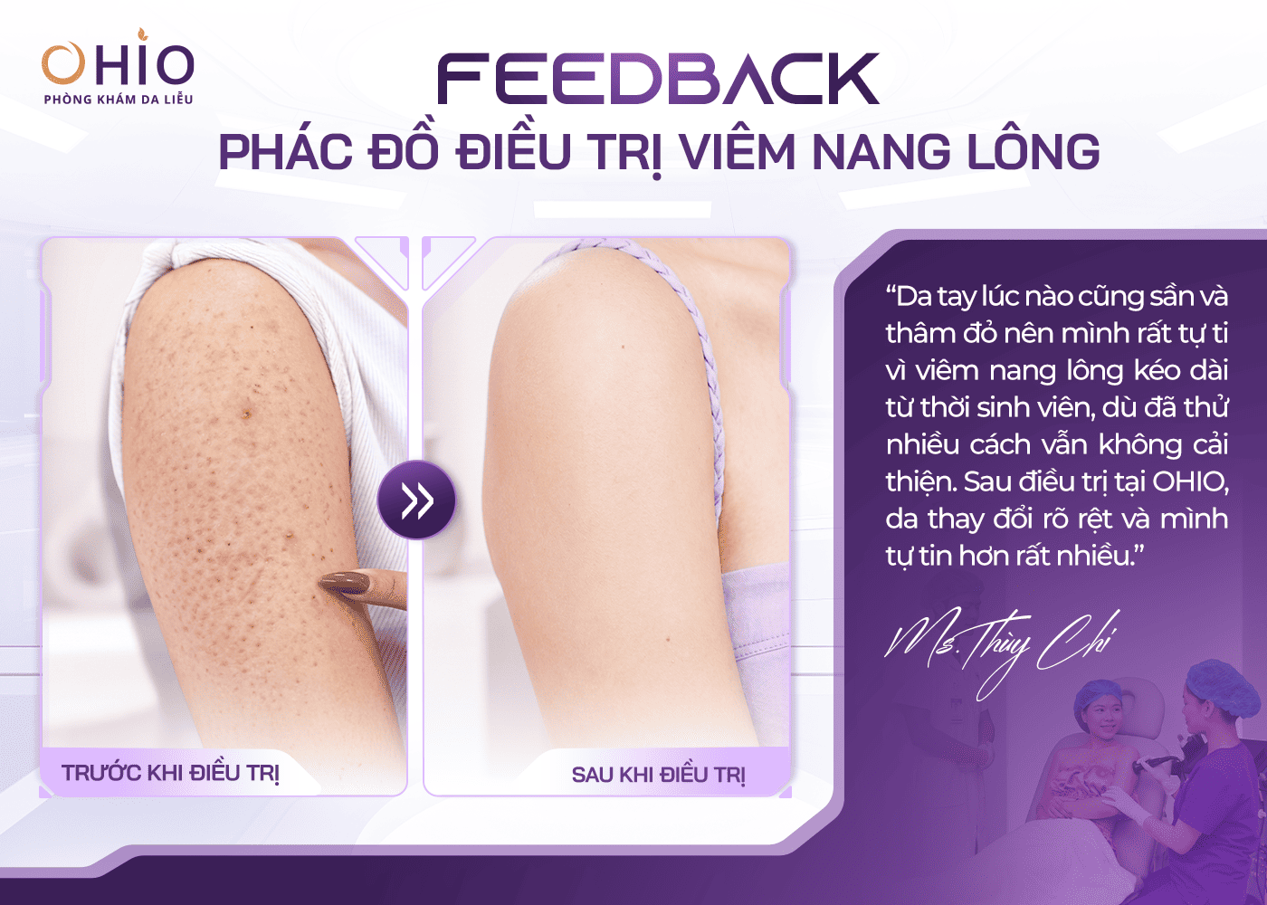 Viêm nang lông: Nhận biết sớm, phòng ngừa và hướng điều trị đúng cách - Phòng khám da liễu OHIO Viêm nang lông: Nhận biết sớm, phòng ngừa và hướng điều trị đúng cách