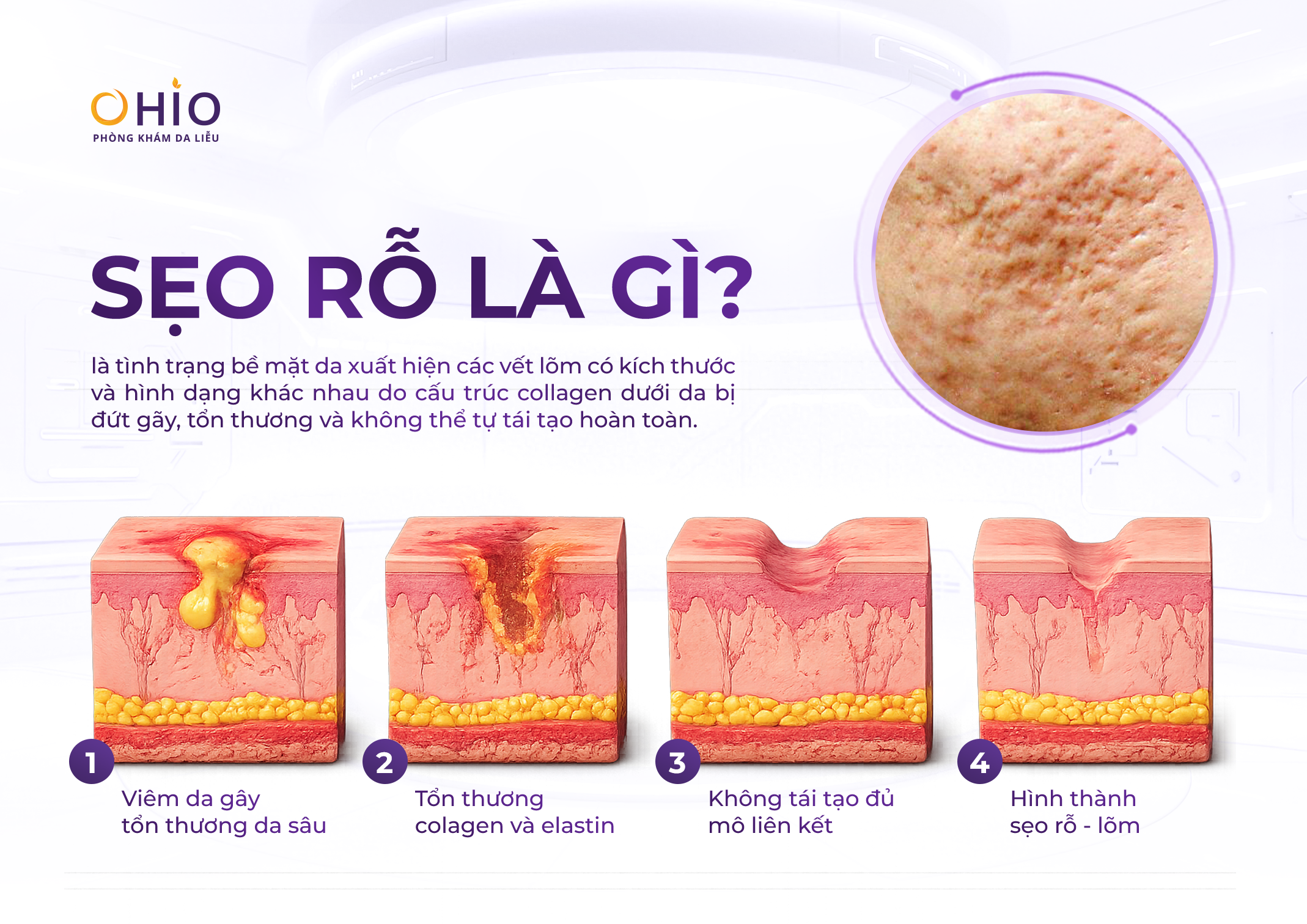 sẹo rỗ là gì