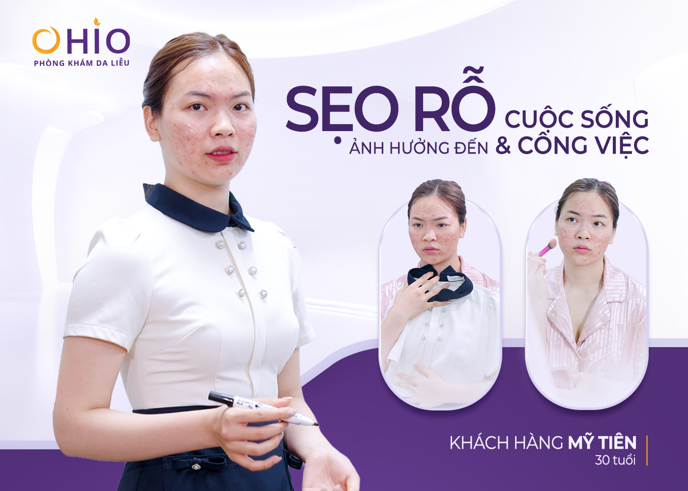 Từ Khủng Hoảng Sẹo Rỗ Sau Sinh Đến Màn “Lột Xác” Lấy Lại Phong Độ Của Luật Sư Mỹ Tiên - Phòng khám da liễu OHIO Từ Khủng Hoảng Sẹo Rỗ Sau Sinh Đến Màn “Lột Xác” Lấy Lại Phong Độ Của Luật Sư Mỹ Tiên