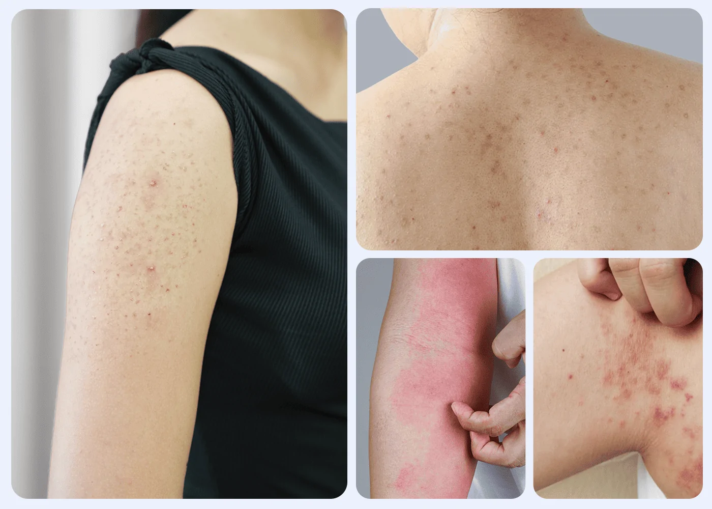 Cảnh báo nguy cơ tiềm tàng khi tự chữa viêm nang lông tại nhà - Phòng khám da liễu OHIO Cảnh báo nguy cơ tiềm tàng khi tự chữa viêm nang lông tại nhà