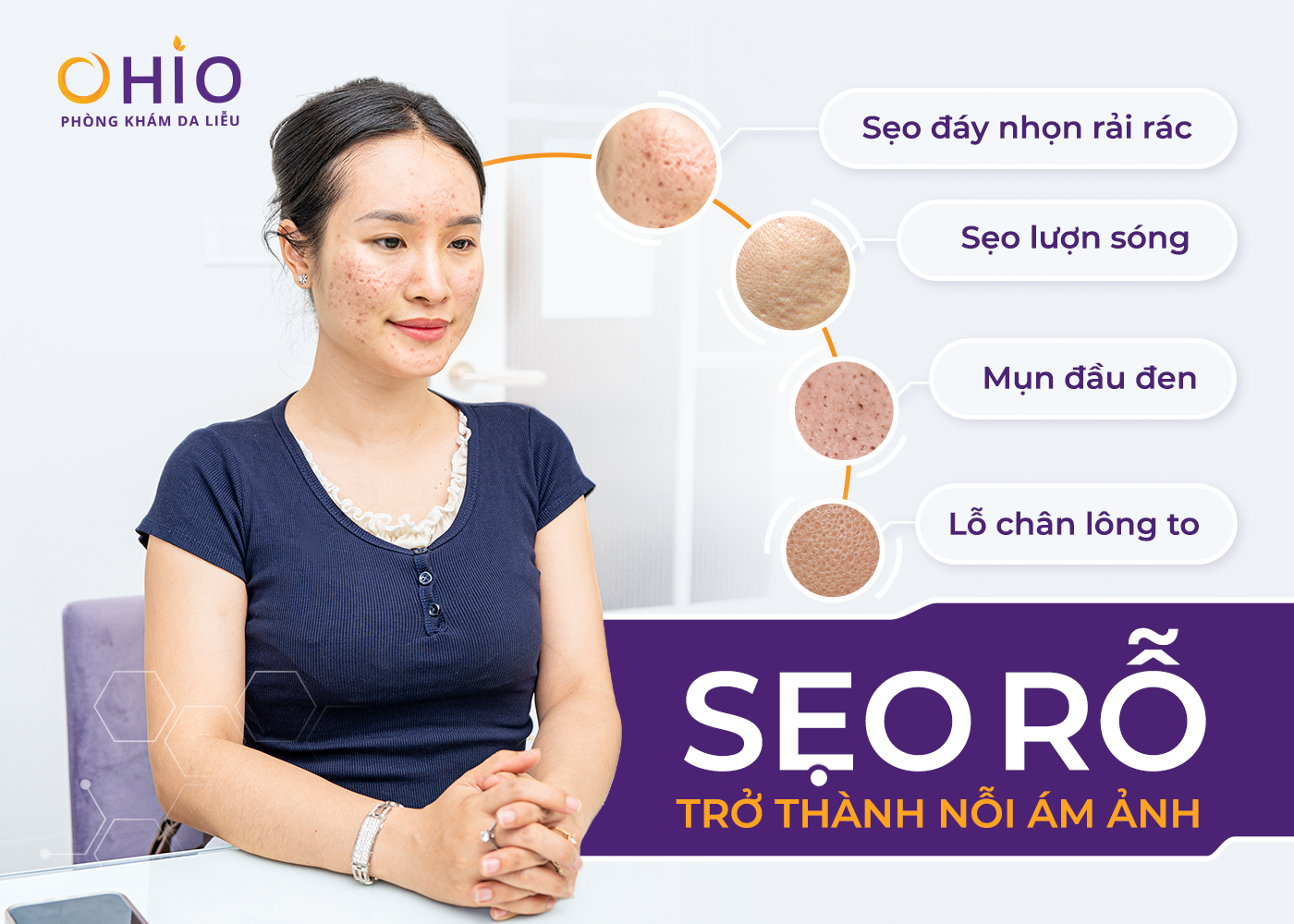 Hành Trình Thoát Khỏi Sẹo Rỗ Sau Nhiều Năm Loay Hoay Điều Trị Của Giảng Viên Yoga Ánh Ngọc