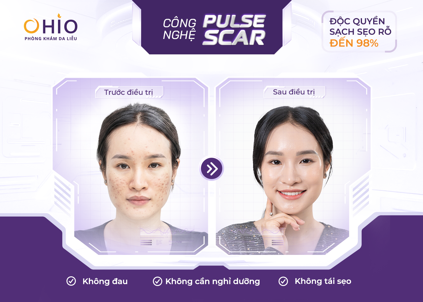 Hành Trình Thoát Khỏi Sẹo Rỗ Sau Nhiều Năm Loay Hoay Điều Trị Của Giảng Viên Yoga Ánh Ngọc