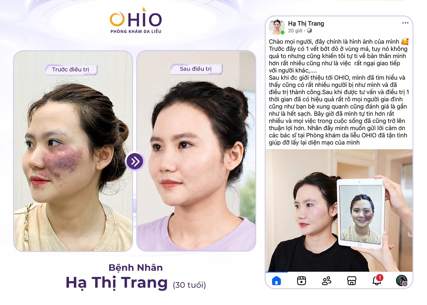 Vết bớt rượu vang: Nguyên nhân, dấu hiệu và cách điều trị hiệu quả - Phòng khám da liễu OHIO Vết bớt rượu vang: Nguyên nhân, dấu hiệu và cách điều trị hiệu quả