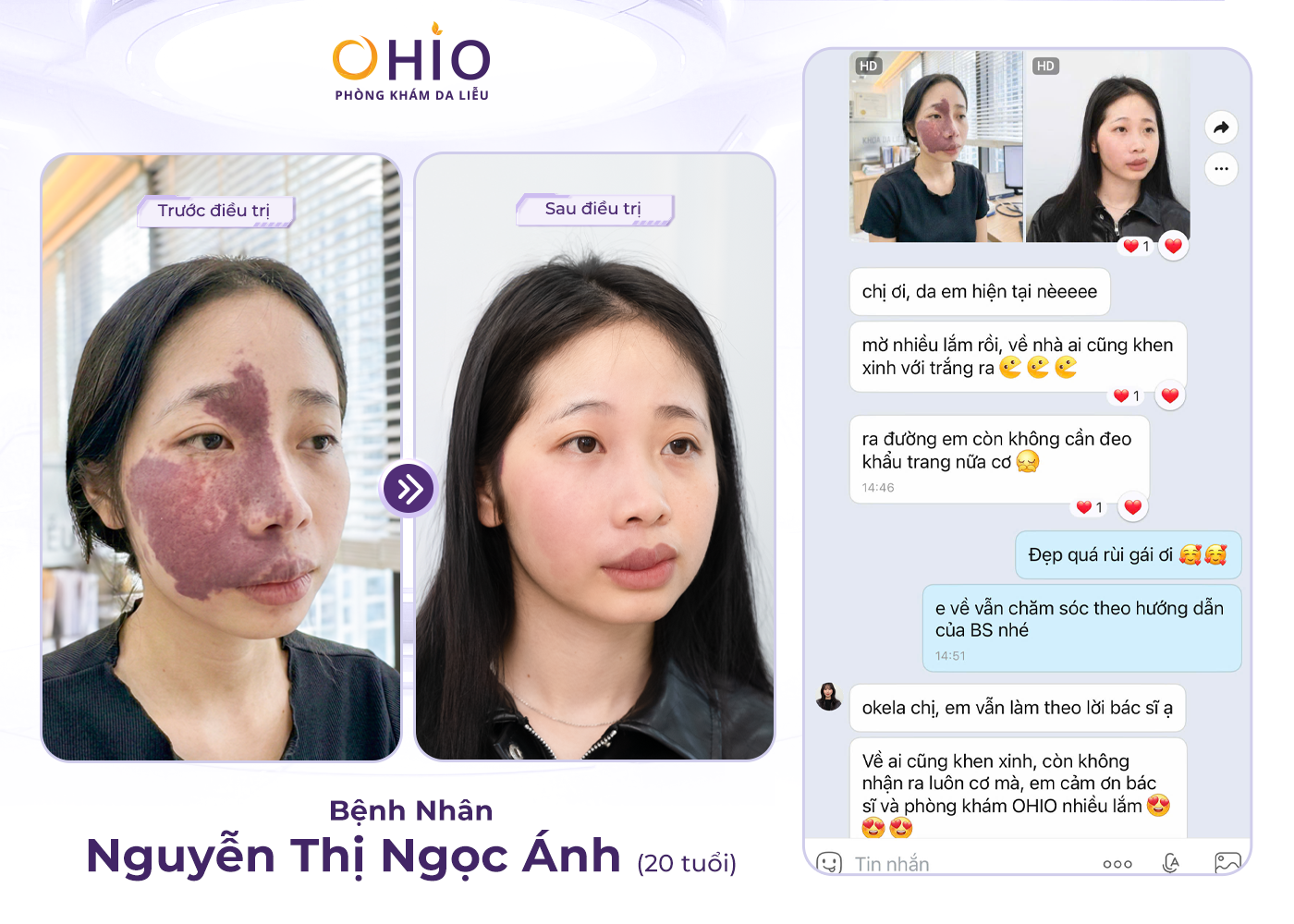 Vết bớt rượu vang: Nguyên nhân, dấu hiệu và cách điều trị hiệu quả - Phòng khám da liễu OHIO Vết bớt rượu vang: Nguyên nhân, dấu hiệu và cách điều trị hiệu quả