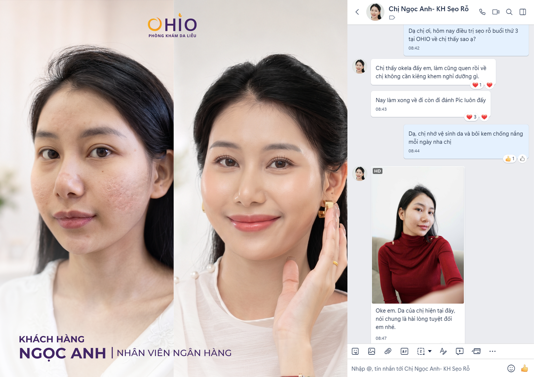 90% Người Trị Sẹo Rỗ Đang Điều Trị Sai Cách Mà Không Biết