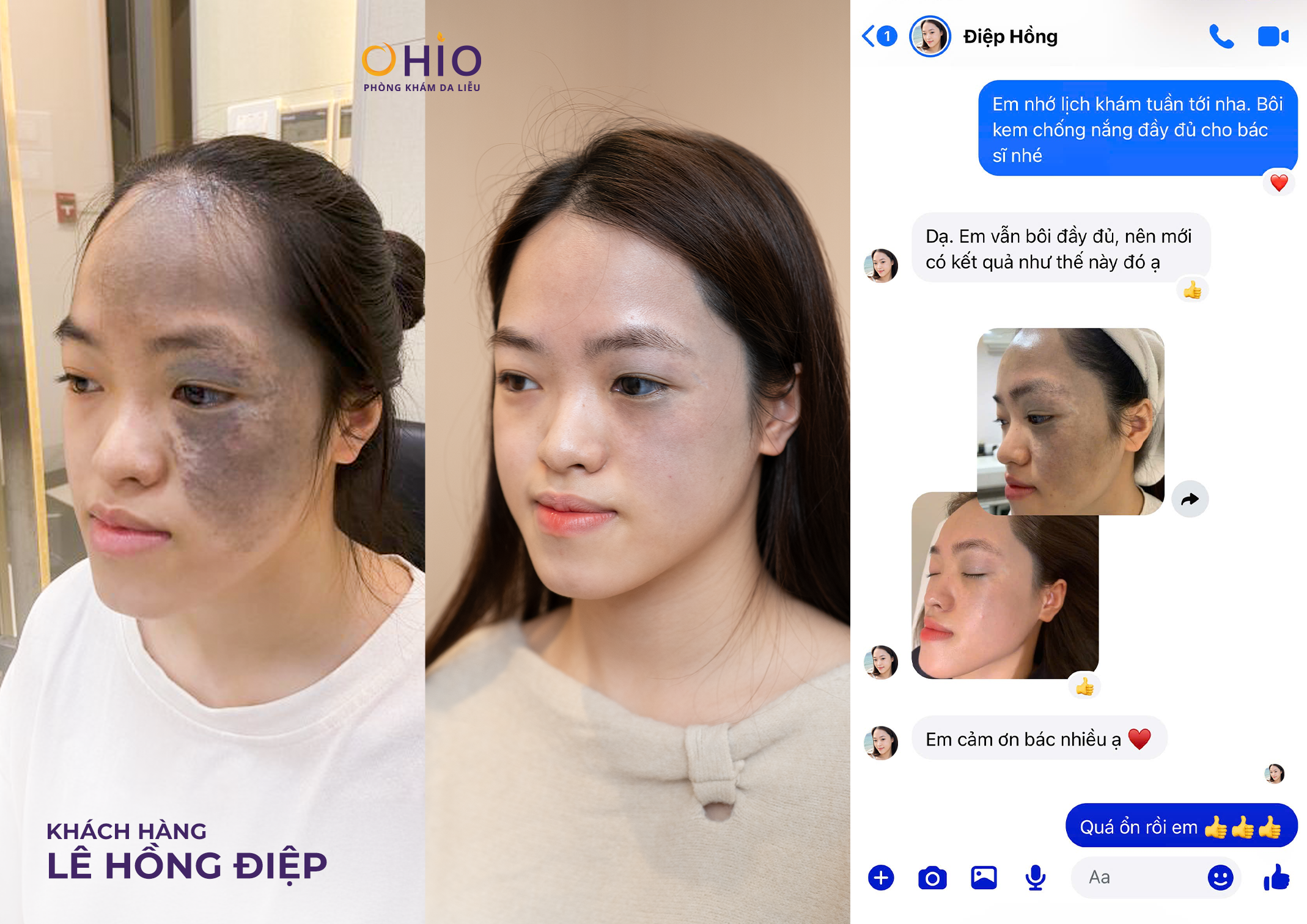 Xóa chàm bớt sắc tố tại OHIO và những điều cần biết