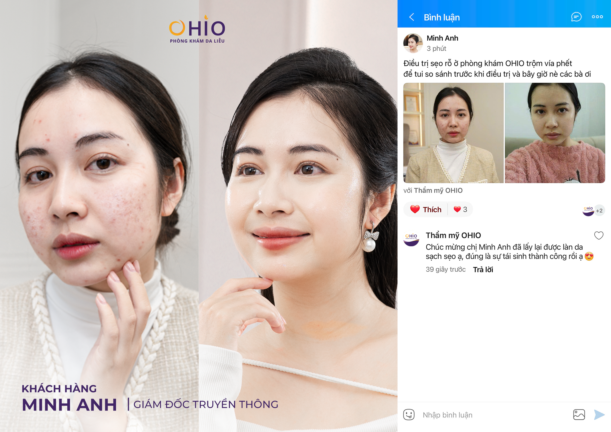 90% Người Trị Sẹo Rỗ Đang Điều Trị Sai Cách Mà Không Biết
