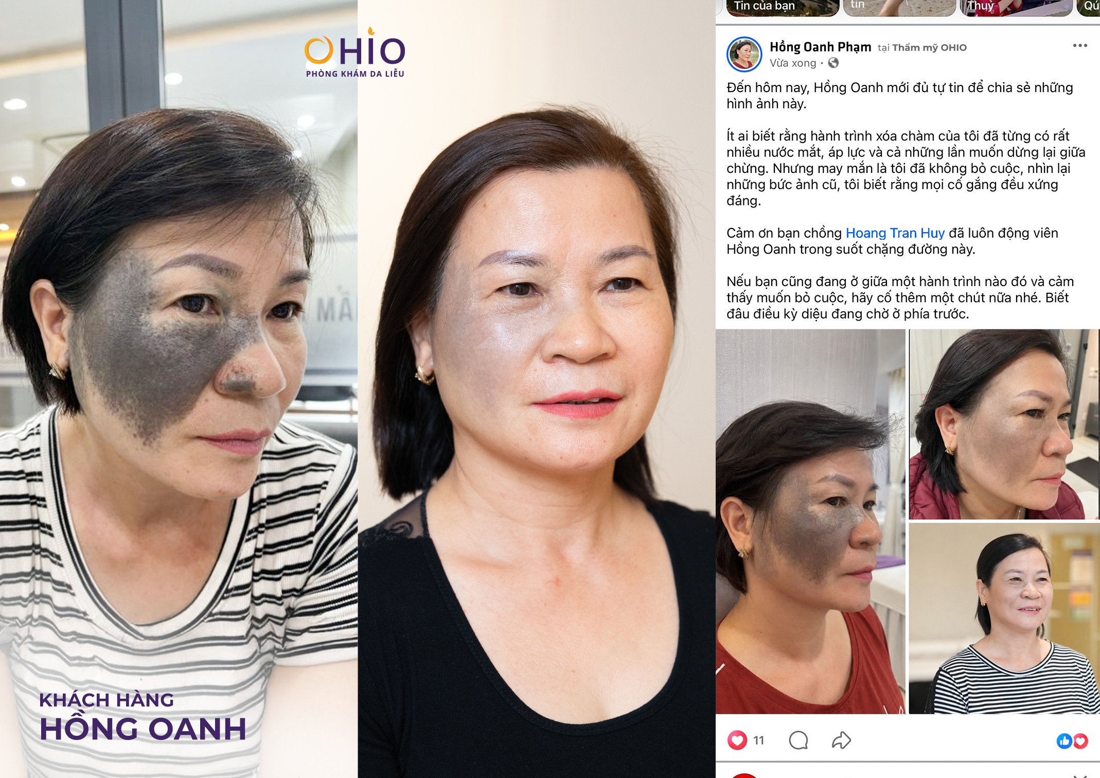Xóa chàm bớt sắc tố tại OHIO và những điều cần biết