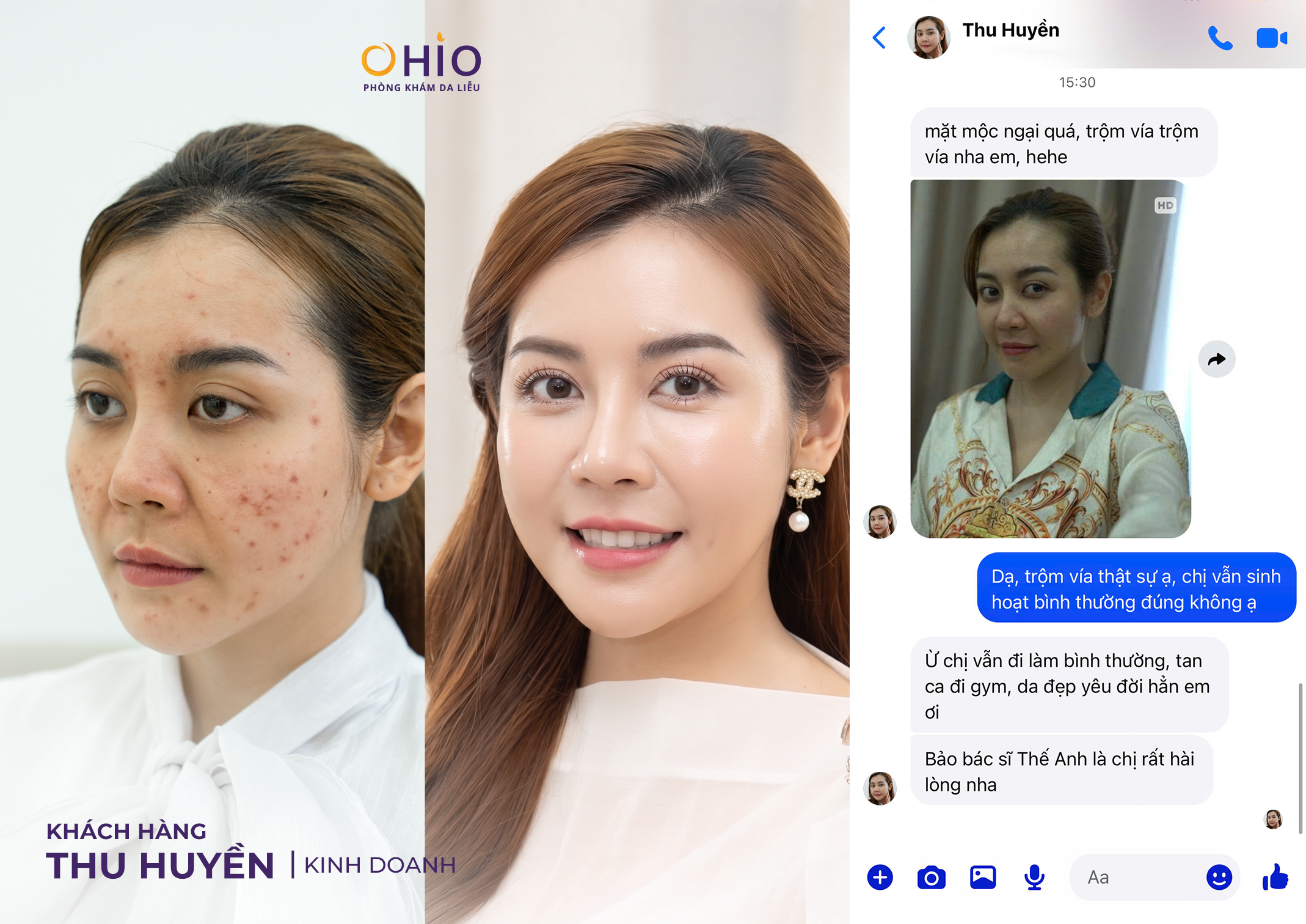 90% Người Trị Sẹo Rỗ Đang Điều Trị Sai Cách Mà Không Biết