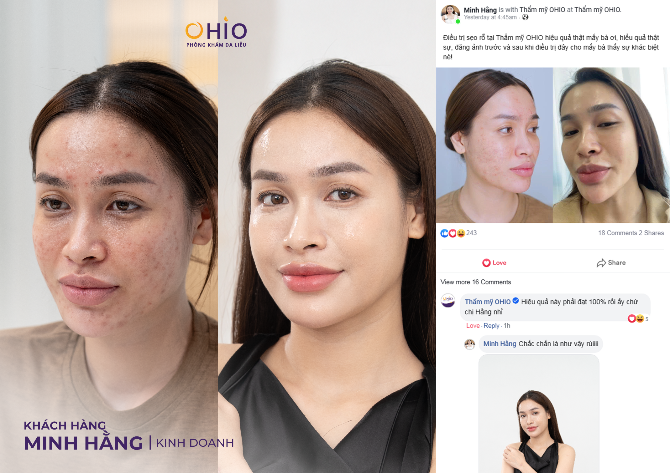 90% Người Trị Sẹo Rỗ Đang Điều Trị Sai Cách Mà Không Biết
