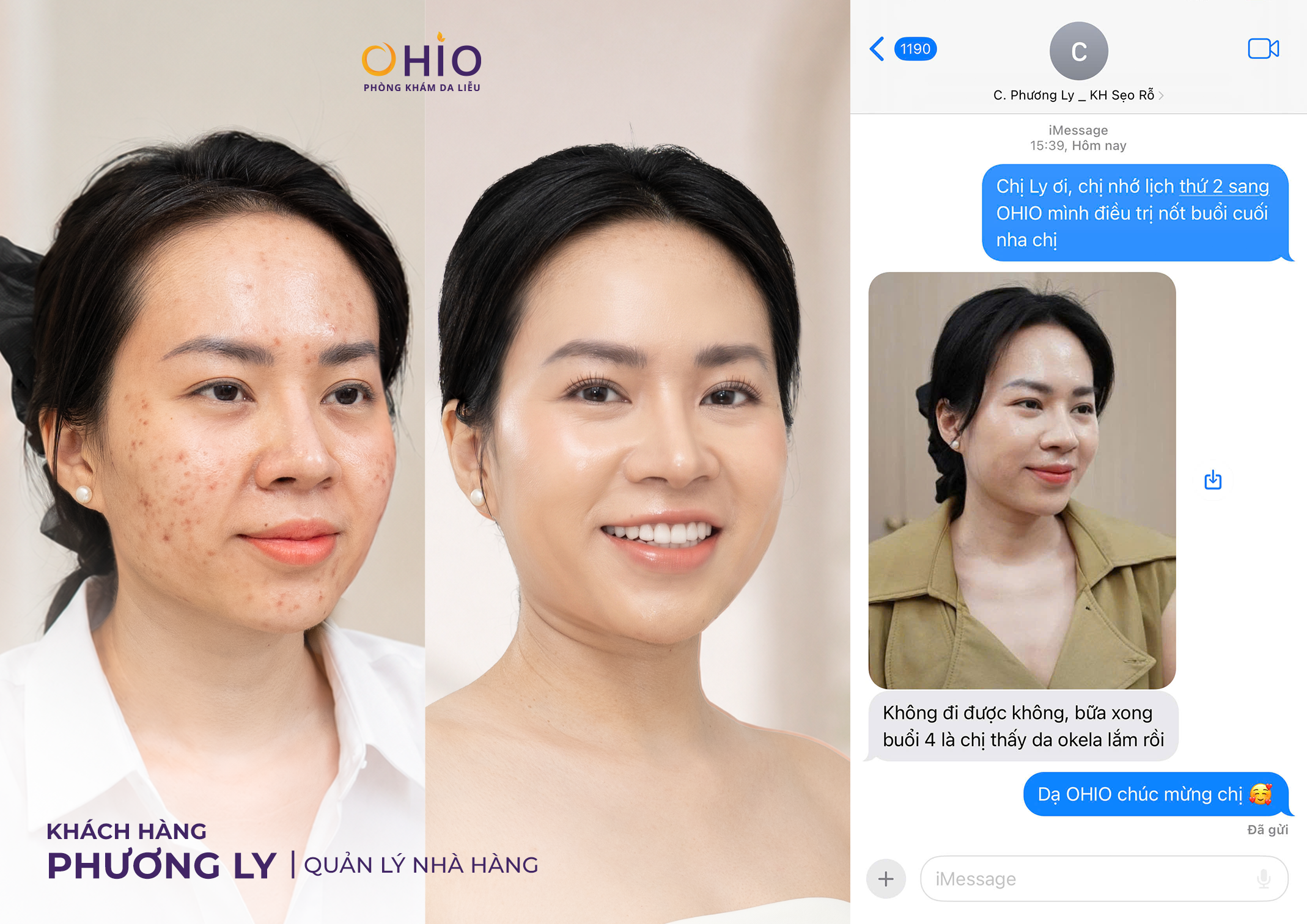 90% Người Trị Sẹo Rỗ Đang Điều Trị Sai Cách Mà Không Biết