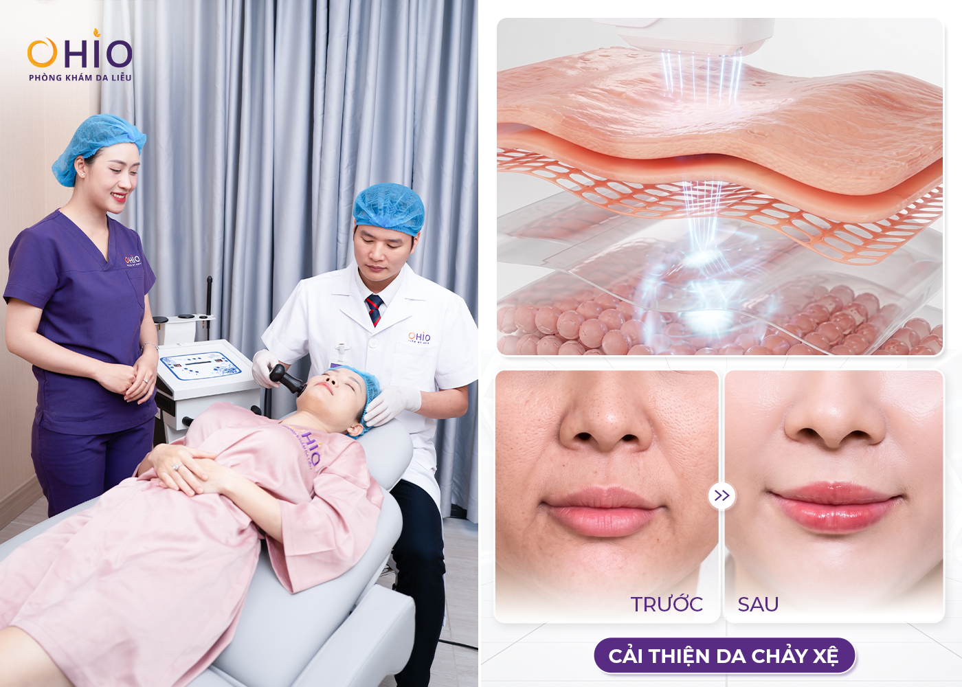 Công nghệ Ultra Deeptech: Nâng cơ trẻ hoá tầng sâu, da đẹp dài lâu - Phòng khám da liễu OHIO Công nghệ Ultra Deeptech: Nâng cơ trẻ hoá tầng sâu, da đẹp dài lâu