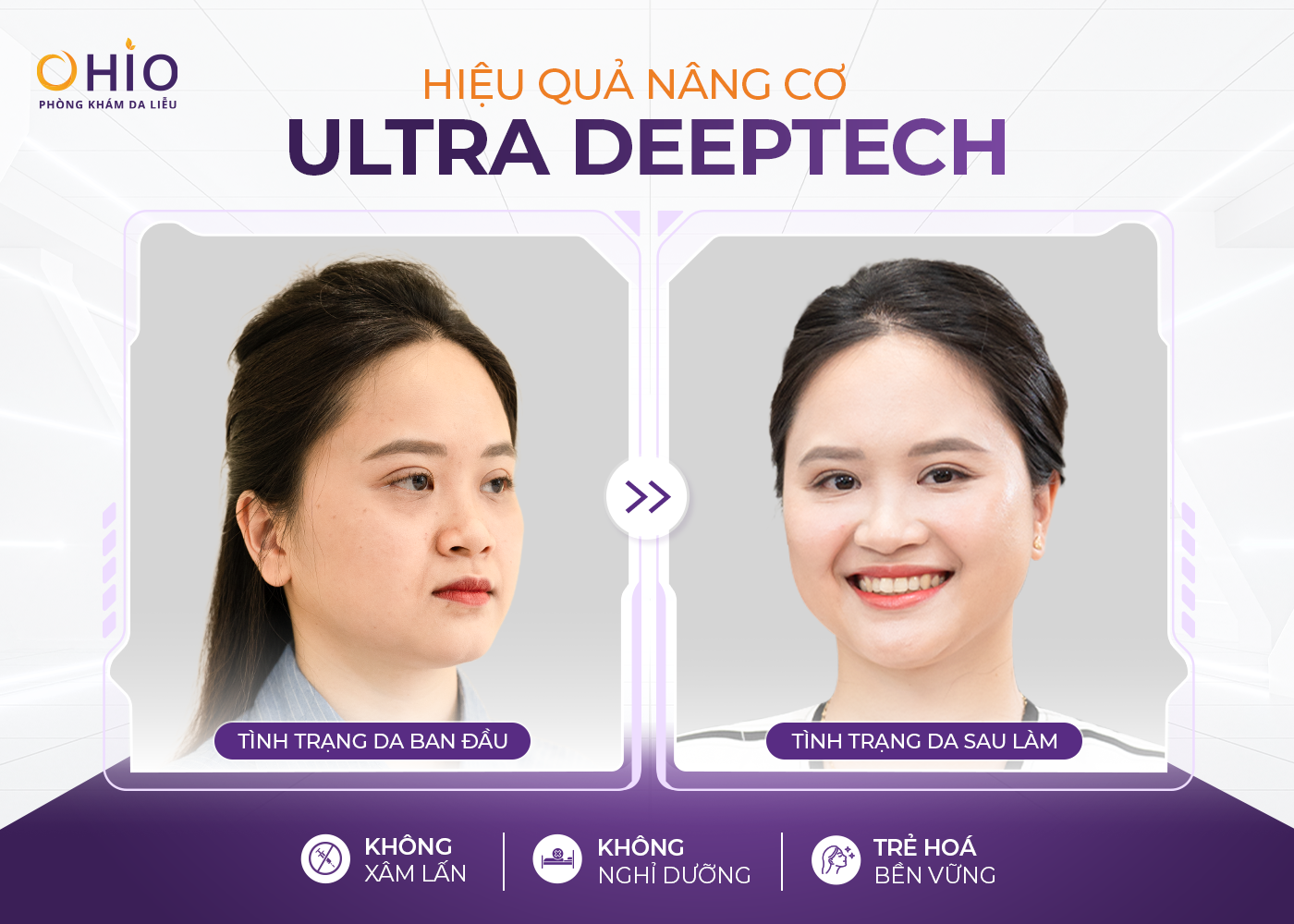 Công nghệ Ultra Deeptech: Nâng cơ trẻ hoá tầng sâu, da đẹp dài lâu - Phòng khám da liễu OHIO Công nghệ Ultra Deeptech: Nâng cơ trẻ hoá tầng sâu, da đẹp dài lâu