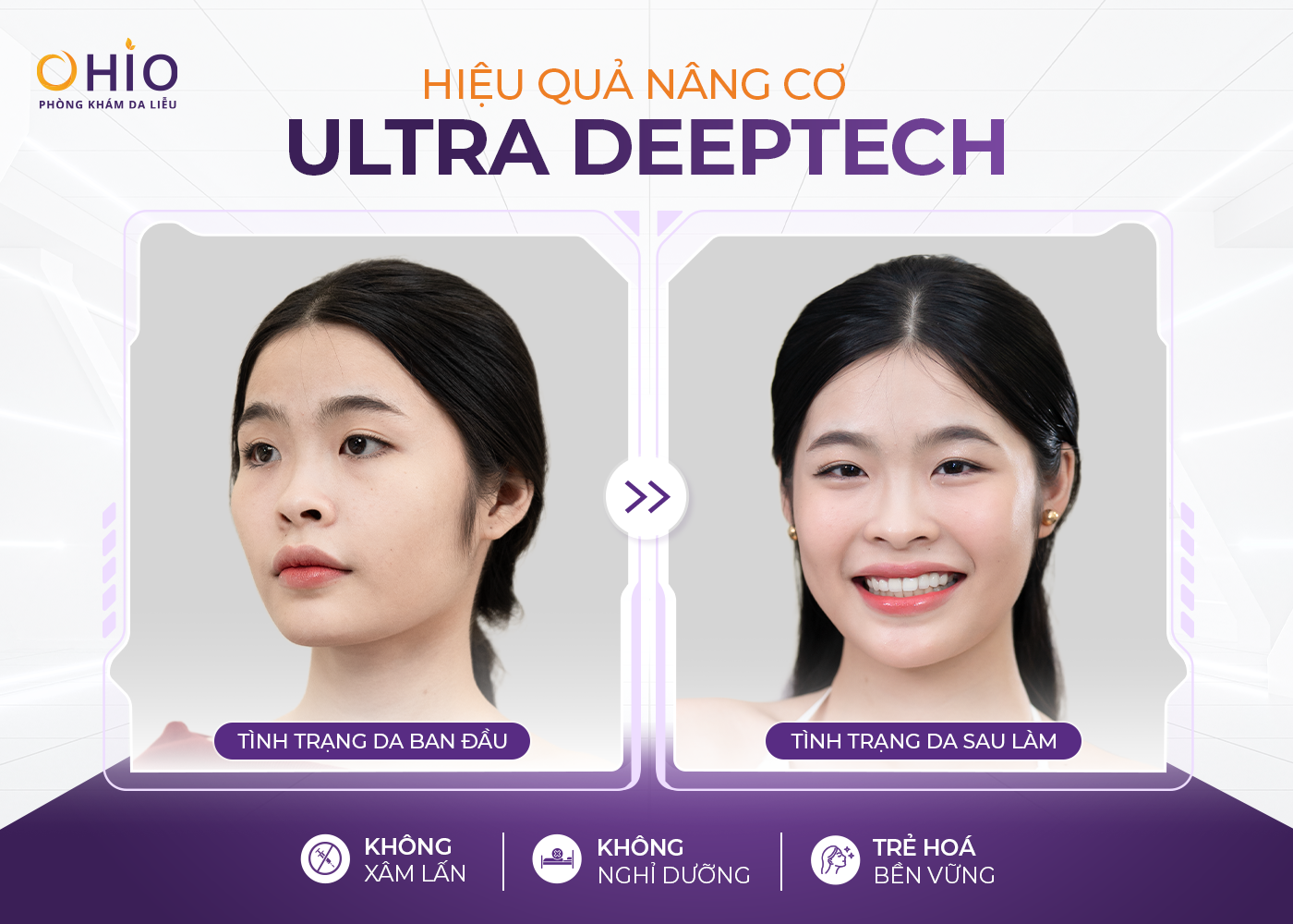 Công nghệ Ultra Deeptech: Nâng cơ trẻ hoá tầng sâu, da đẹp dài lâu - Phòng khám da liễu OHIO Công nghệ Ultra Deeptech: Nâng cơ trẻ hoá tầng sâu, da đẹp dài lâu